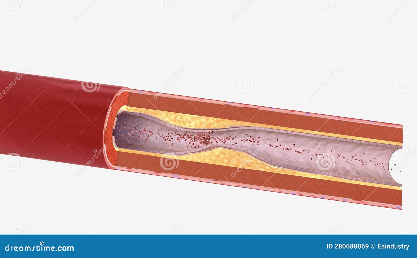 Atherosclerosis is the Plaque Buildup in the Walls of the Arteries