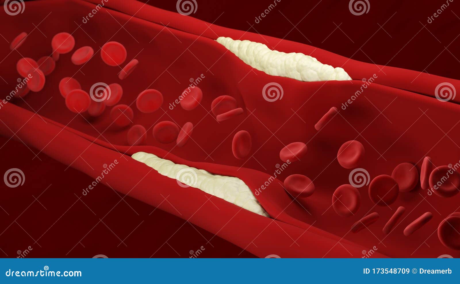 atherosclerosis. red blood cells. artery. build up of plaque. loss of elasticity of the walls of arteries.