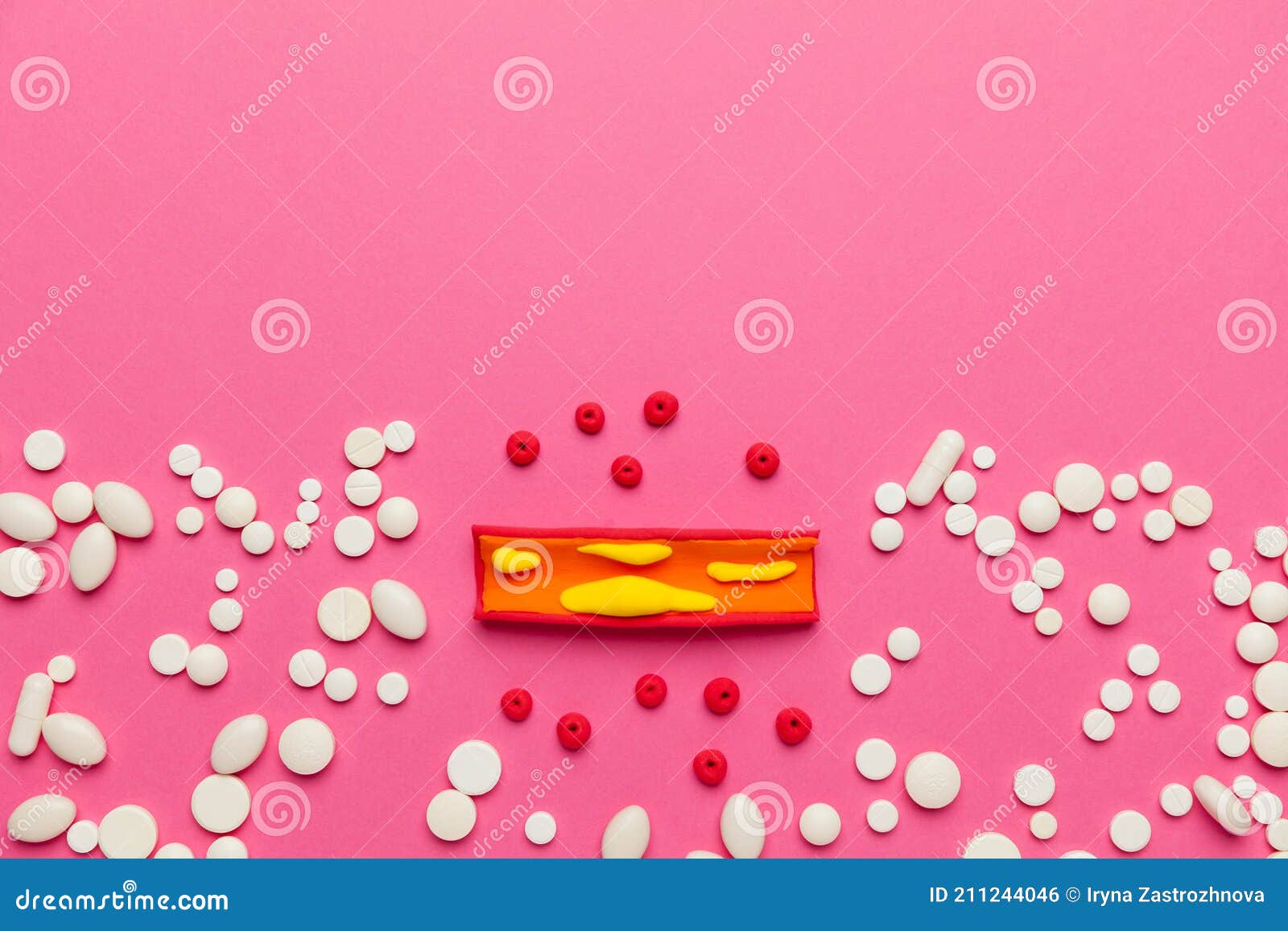 Atherosclerotic Plaques. Treatment of the Cardiovascular System Stock