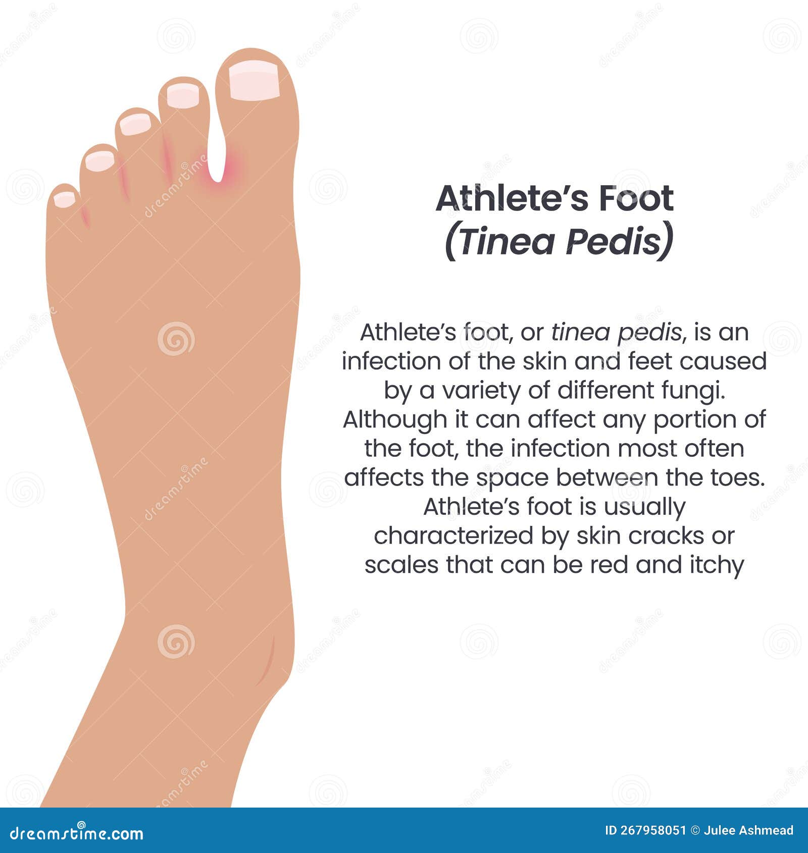 Athlete S Foot Tinea Pedis Vector Illustration Vector Infographic Stock  Vector - Illustration of health, toenails: 267958051