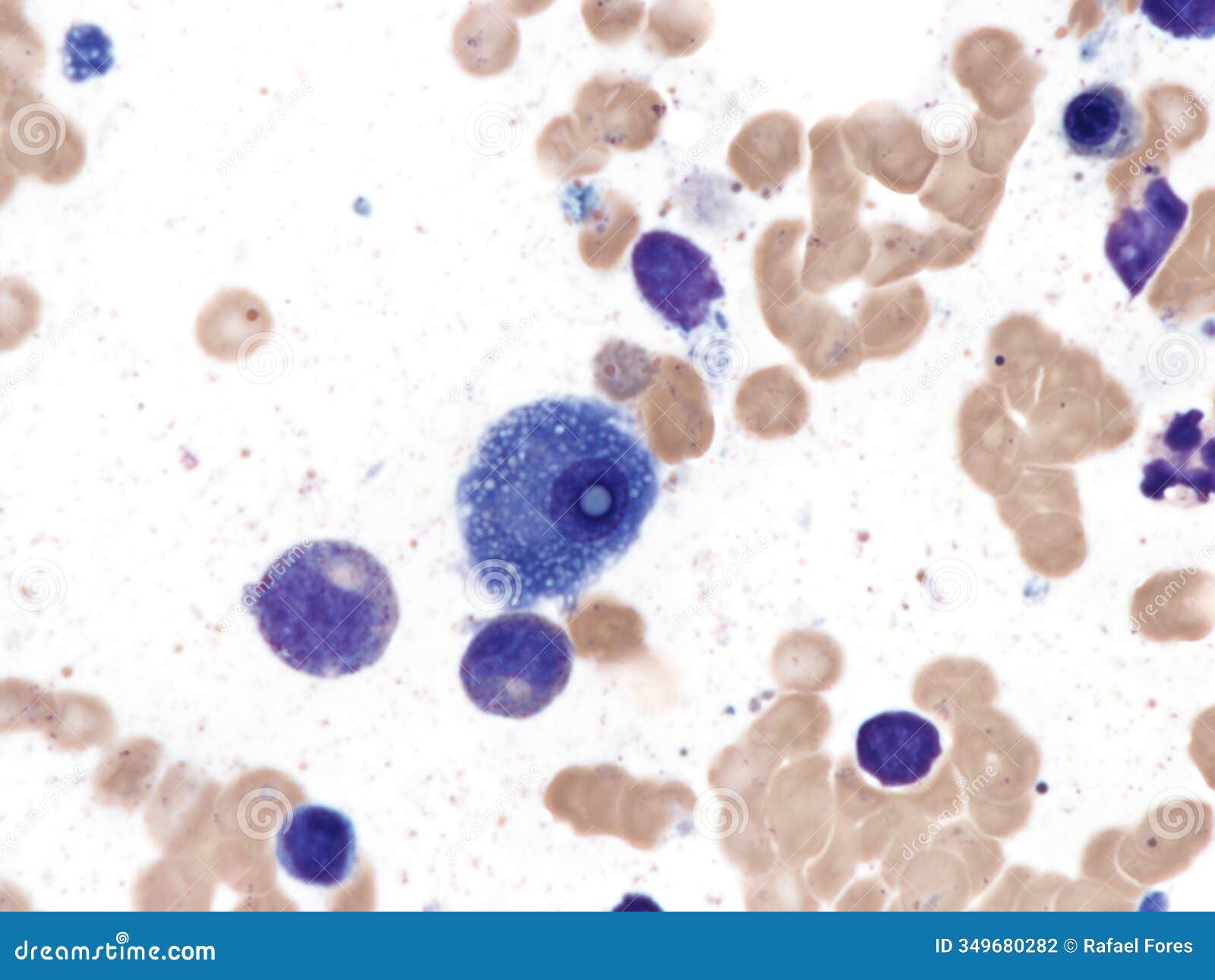 atipycal plasma cell whith dutcher body.