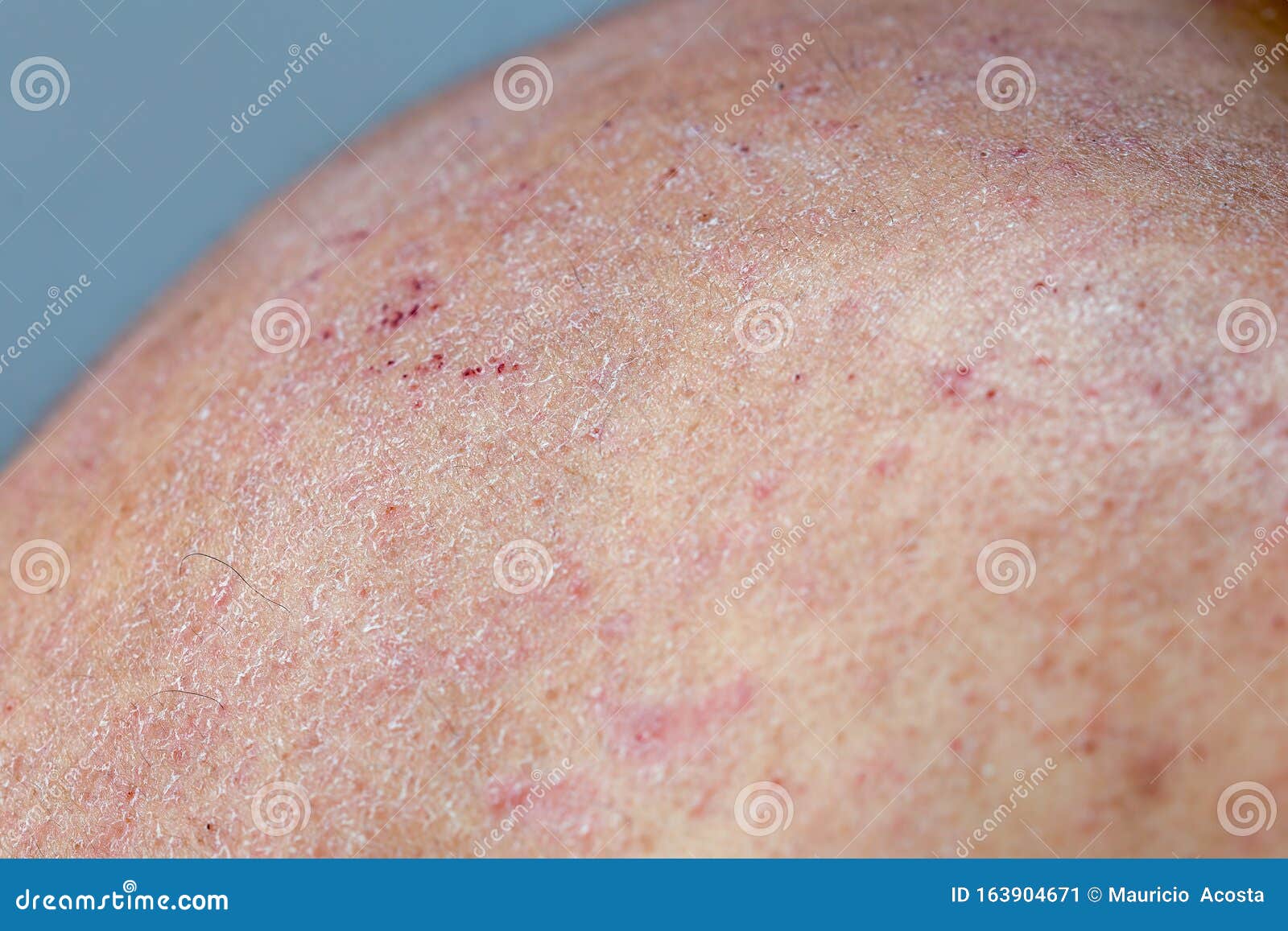 Atocpic Dermatitis Symptoms On The Right Shoulder Stock Image