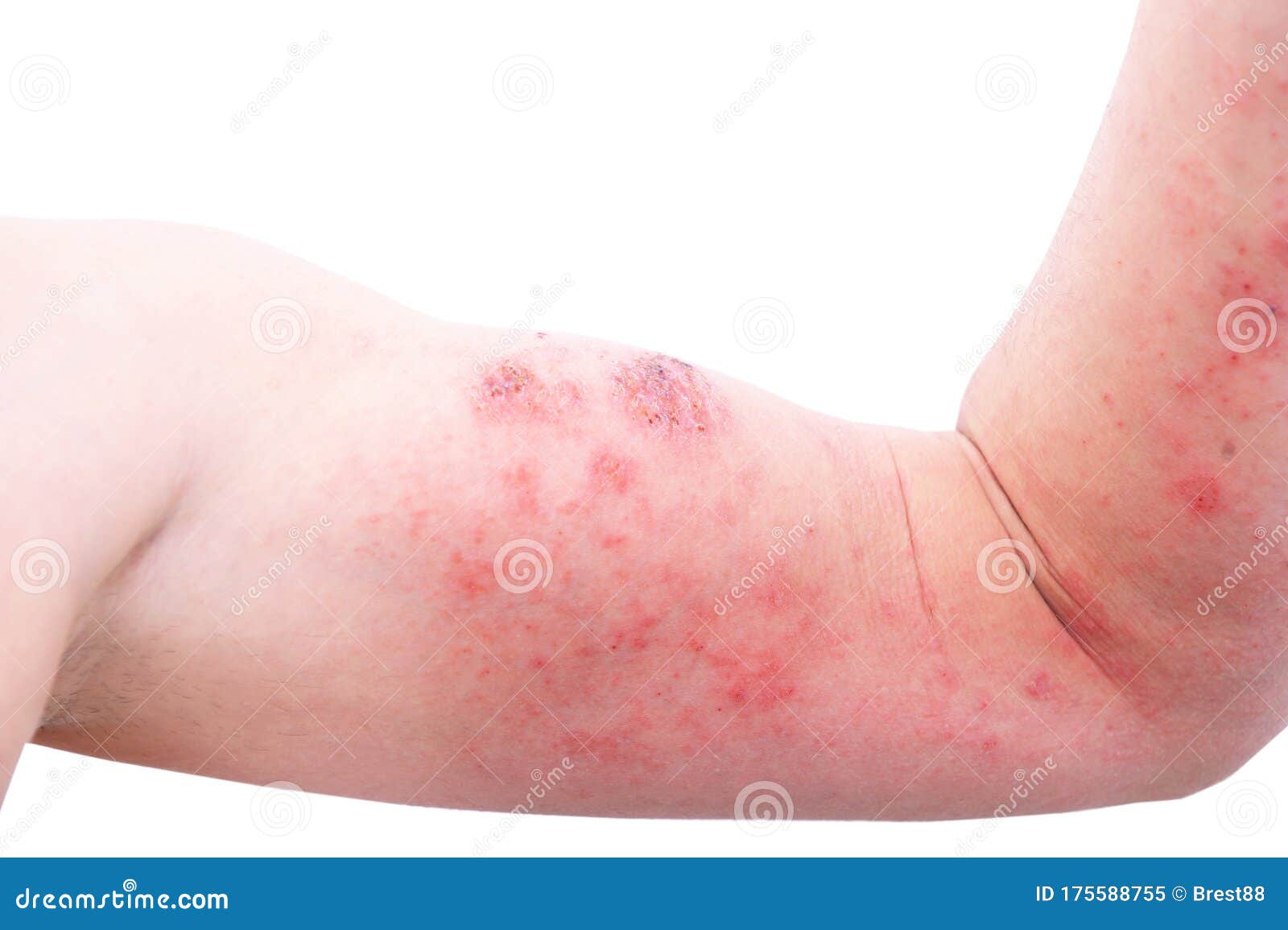 atopic dermatitis ad, also known as atopic eczema, is a type of inflammation of the skin dermatitis at foot.