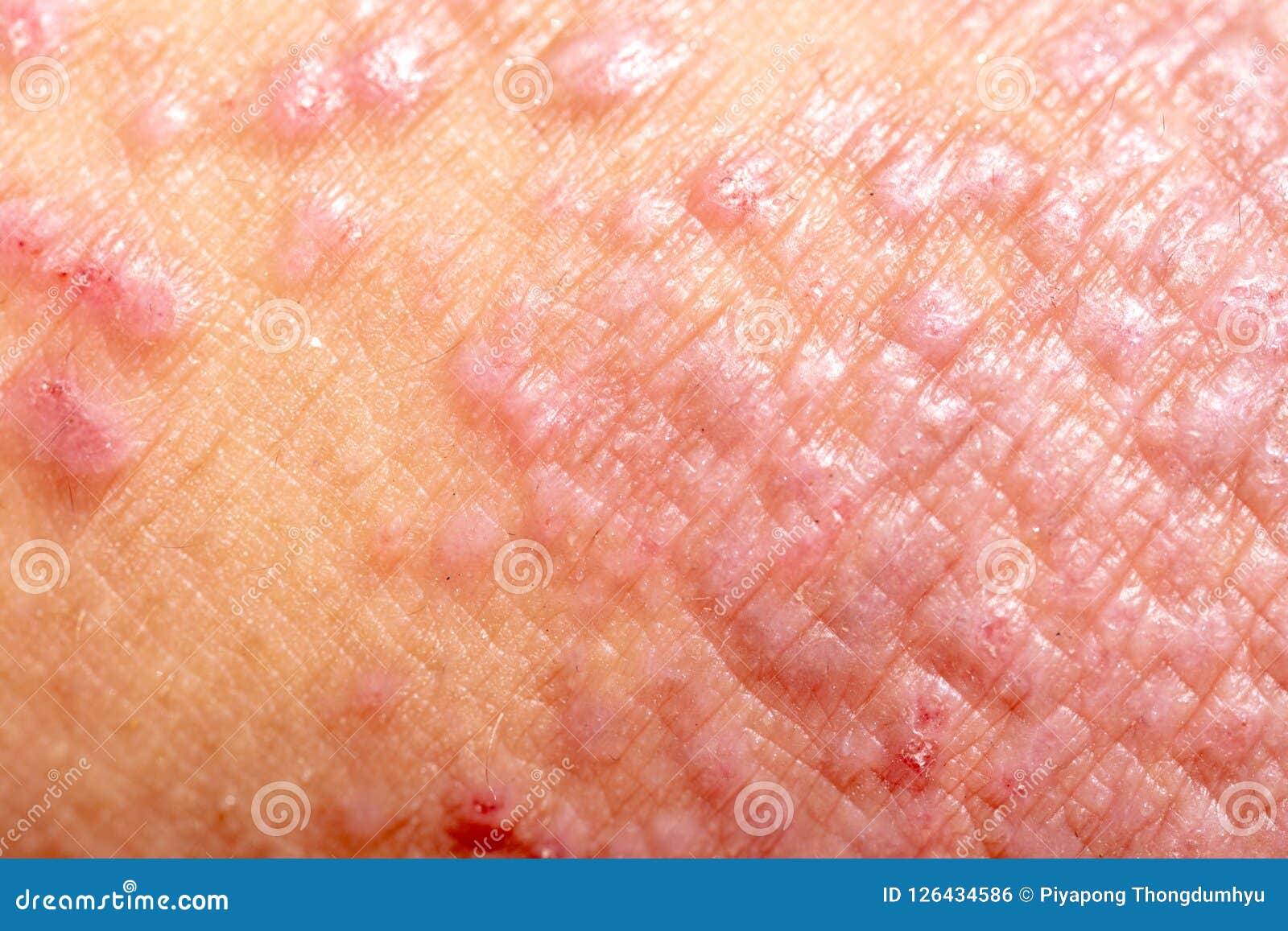 What is eczema?