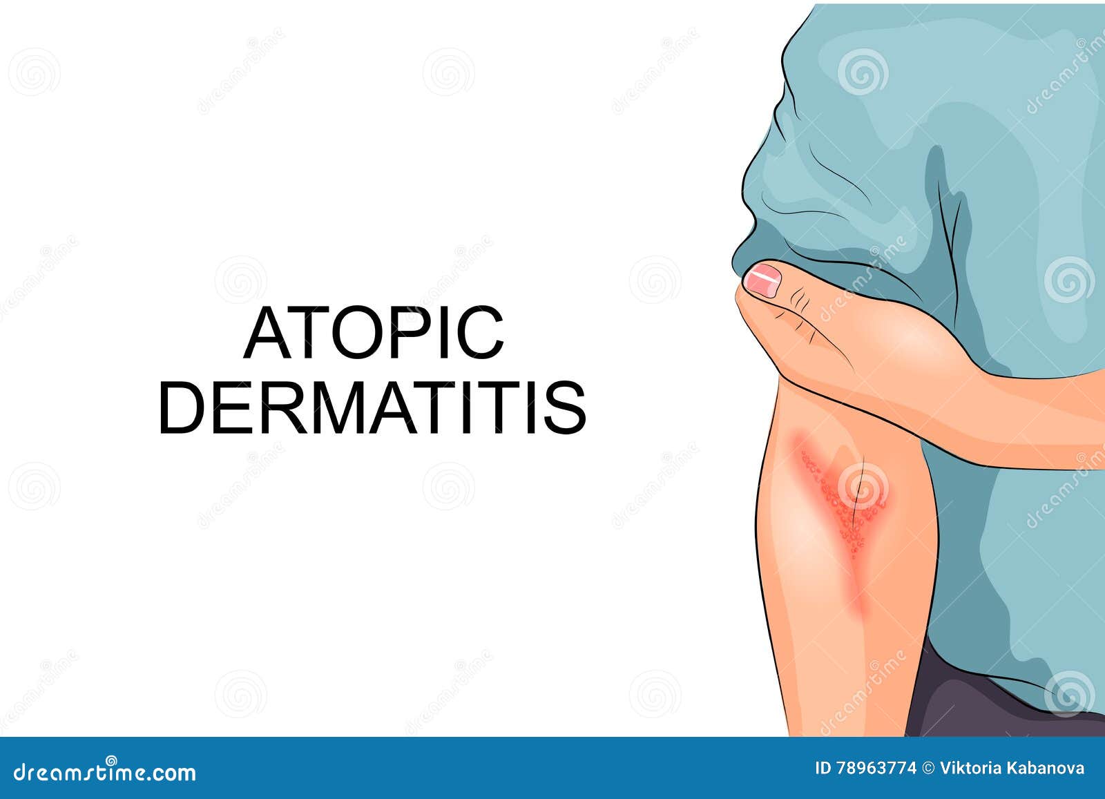 atopic dermatitis. allergy