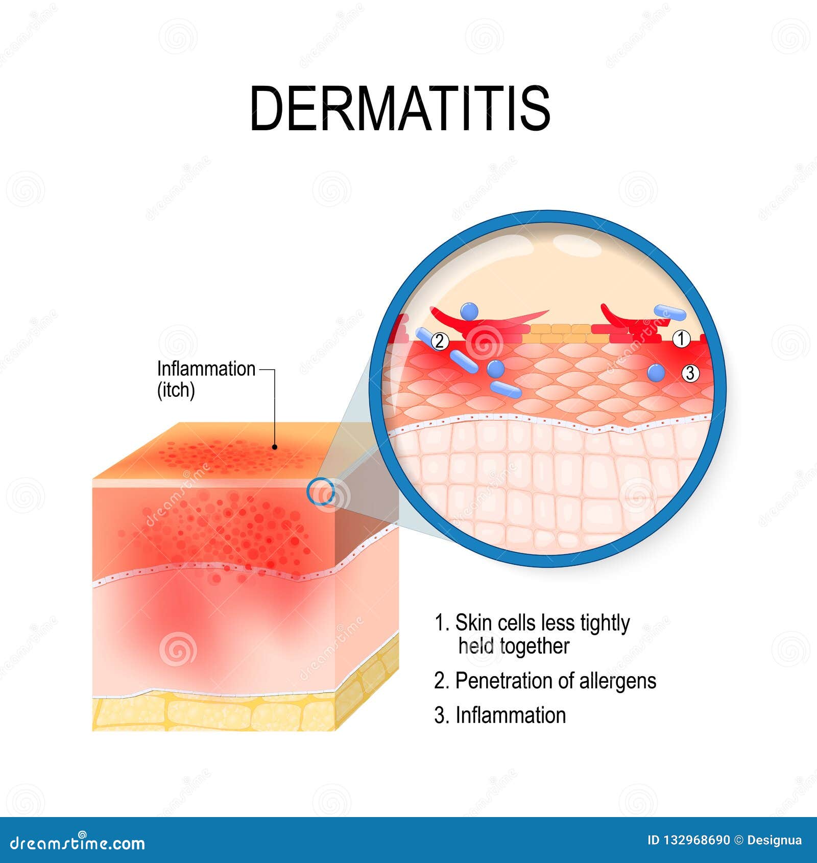 atopic dermatitis atopic eczema