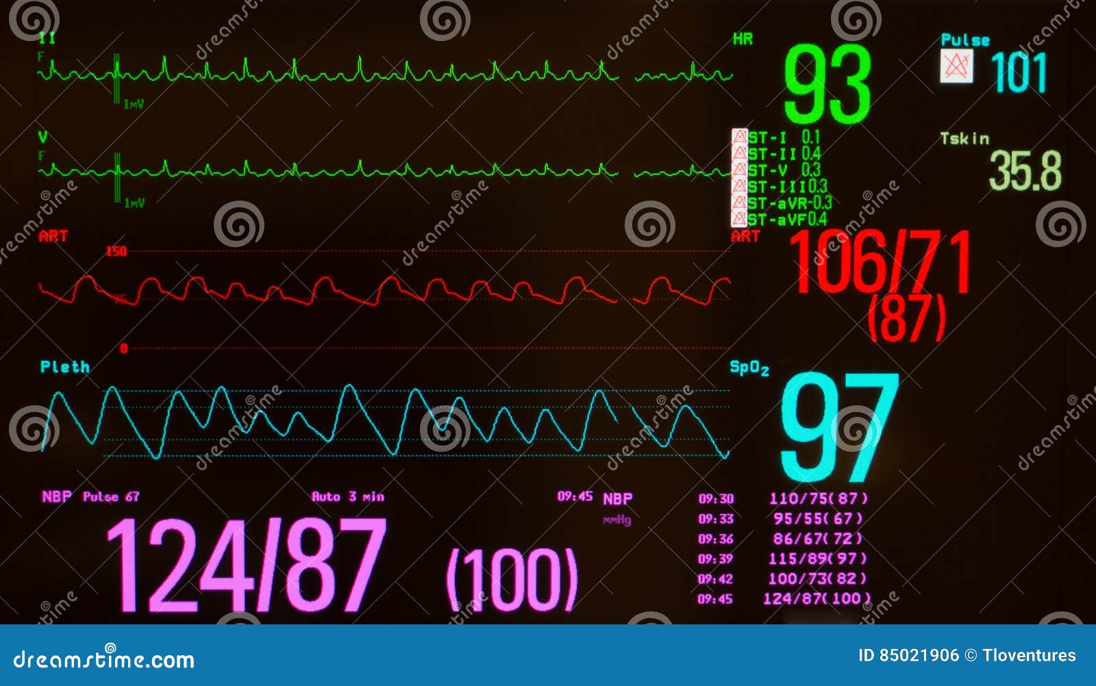 atrial flutter and vital signs