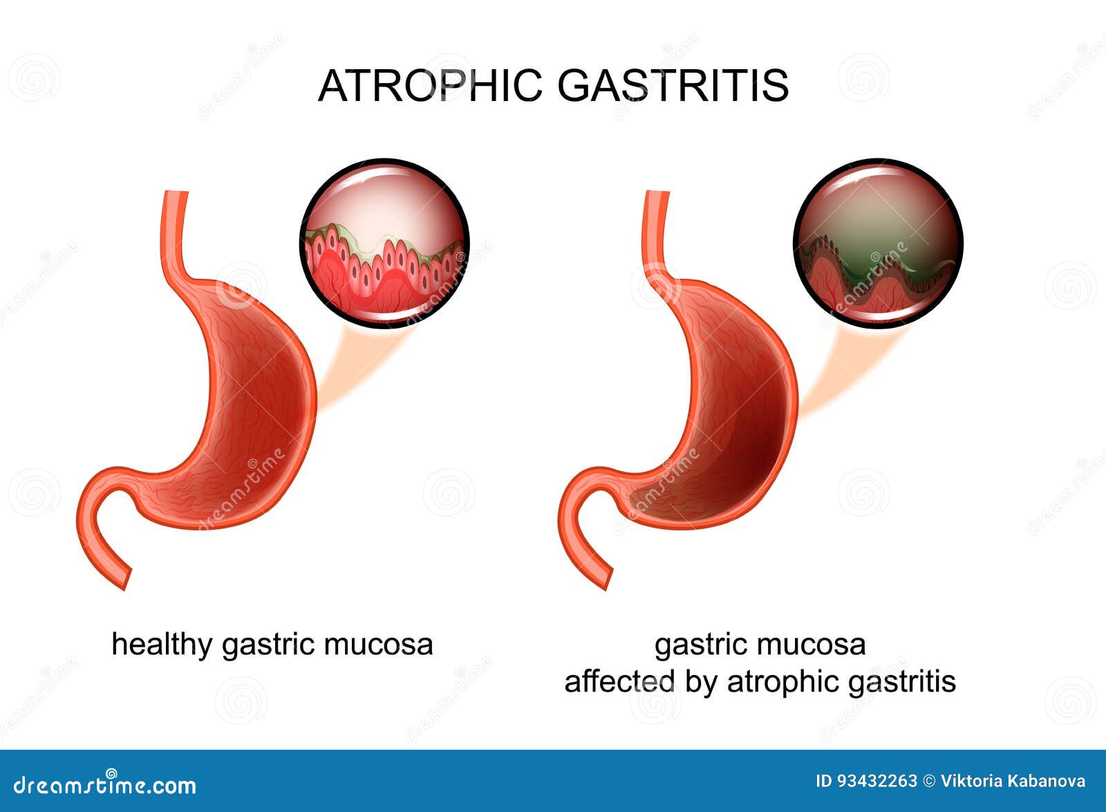 atrophic gastritis. inflammation