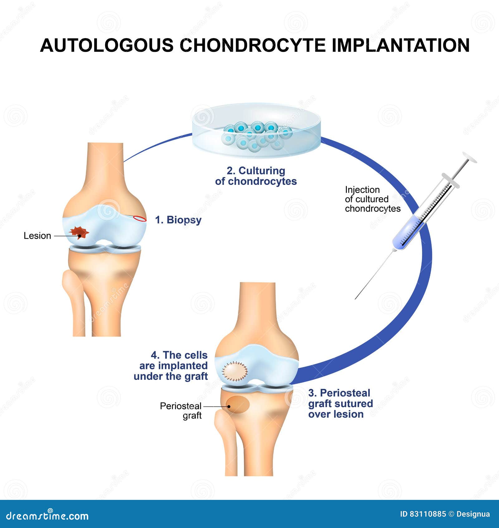 autologous chondrocyte implantation