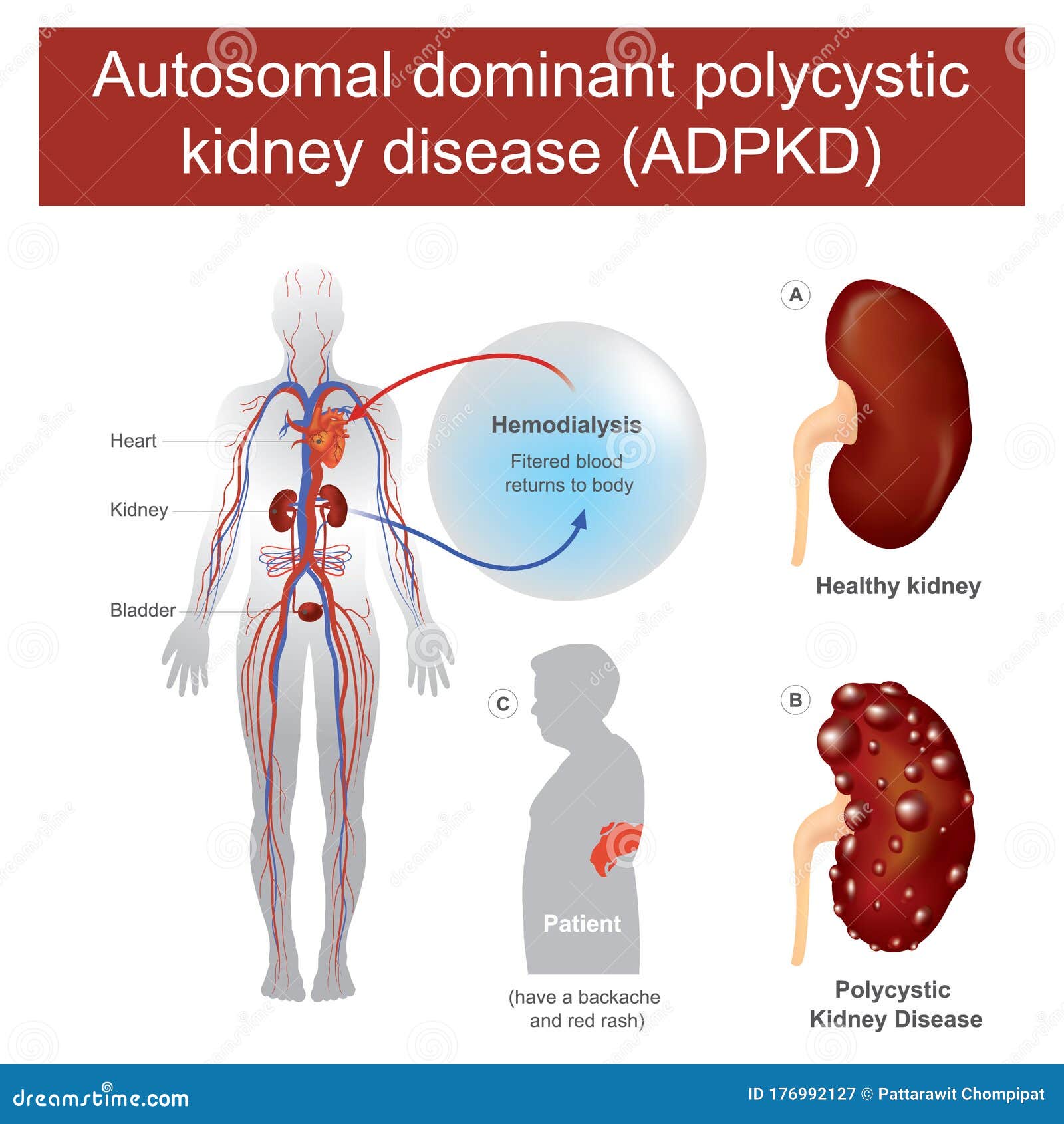 autosomal dominant polycystic kidney disease.