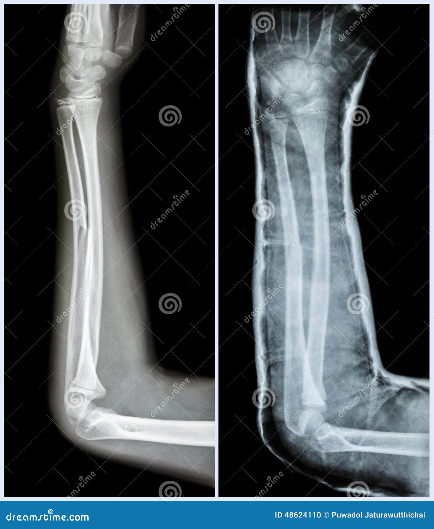 Axe De Fracture D'os Ulnaire (os D'avantbras) Photo stock Image du