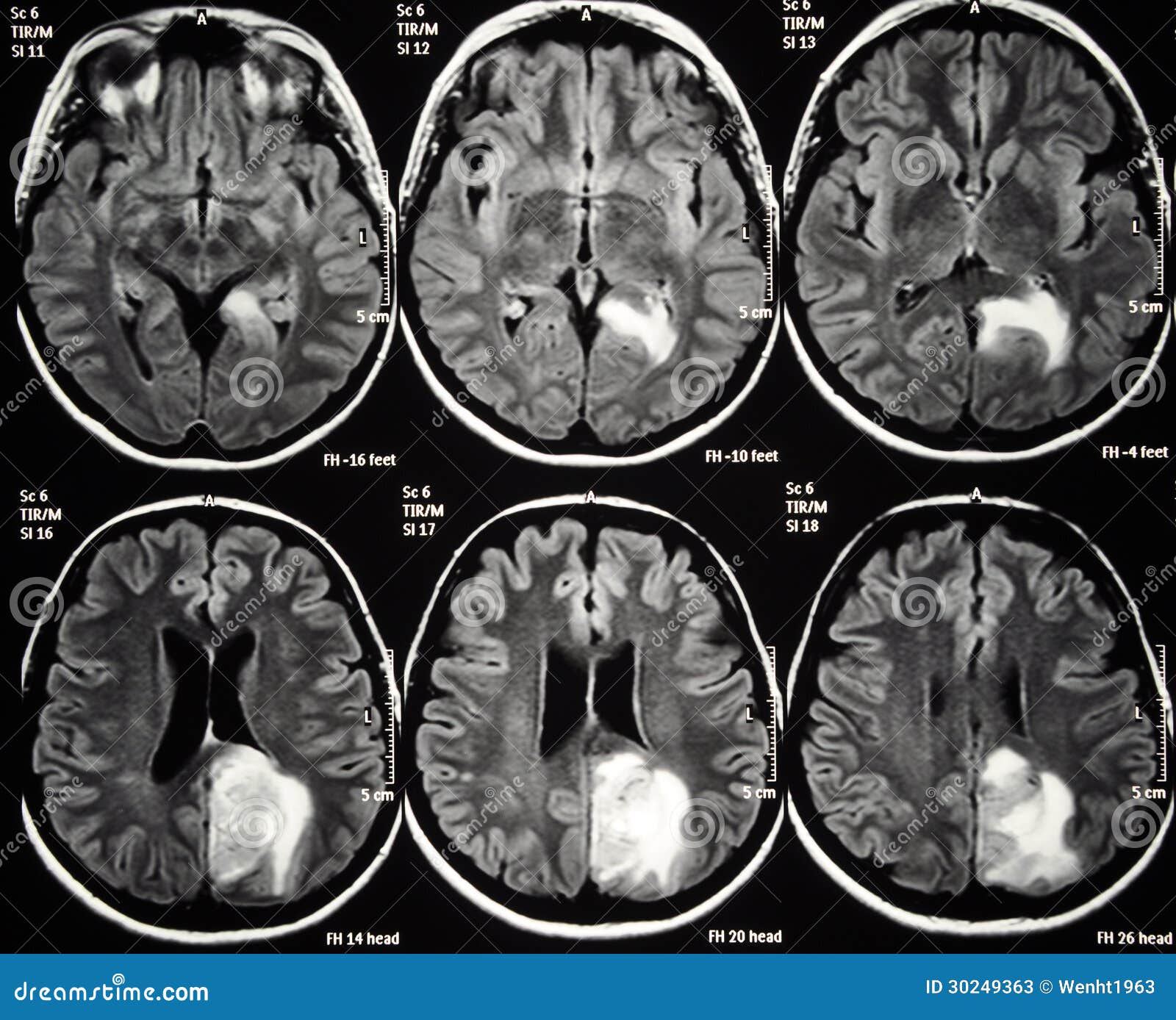 brain tumor