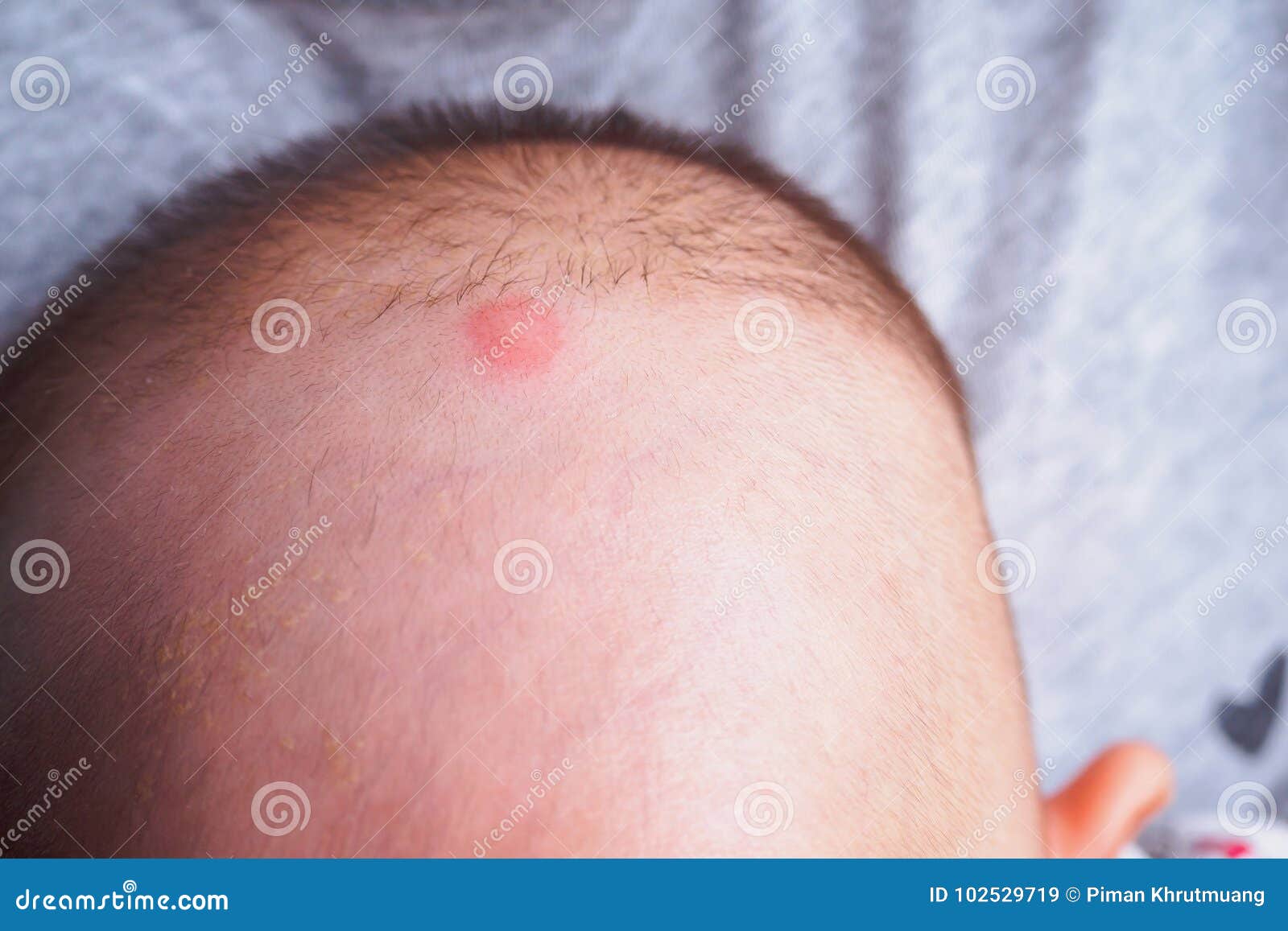 Bebe Avec La Tache Rouge De Piqure De Moustique Sur La Tete Image Stock Image Du Mignon Irritez