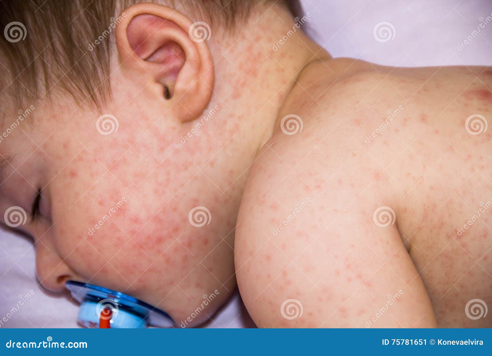 Bebe Avec Le Probleme De Dermatite De L Eruption Douleur Impetueuse D Allergie Des Allergies Alimentaires Symptome En Gros Plan D Image Stock Image Du Degagement Maladie Bebe Avec Le Probleme De Dermatite De L Eruption Douleur Impetueuse D Allergie Des Allergies Alimentaires Symptome En Gros Plan D Image Stock Image Du Degagement Maladie