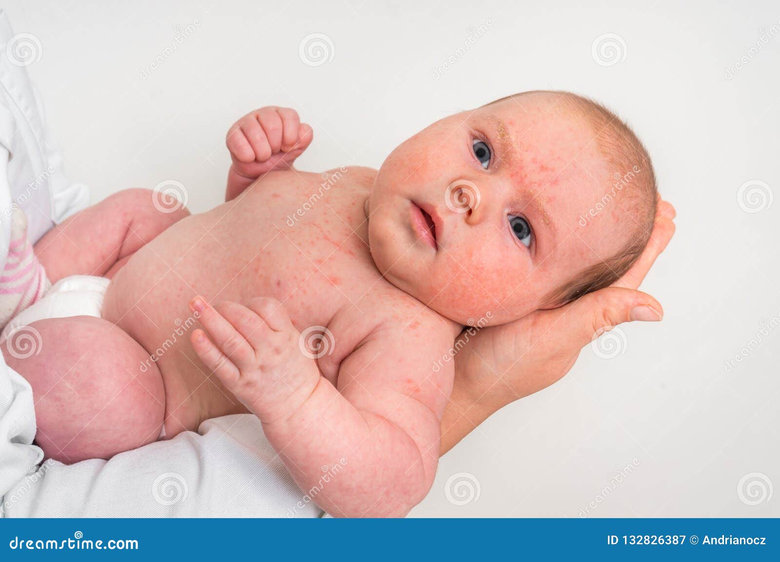 Bebe Nouveau Ne Avec L Eruption Cutanee Reaction Allergique Apres Naissance Image Stock Image Du Visage Maladie Bebe Nouveau Ne Avec L Eruption Cutanee Reaction Allergique Apres Naissance Image Stock Image Du Visage Maladie