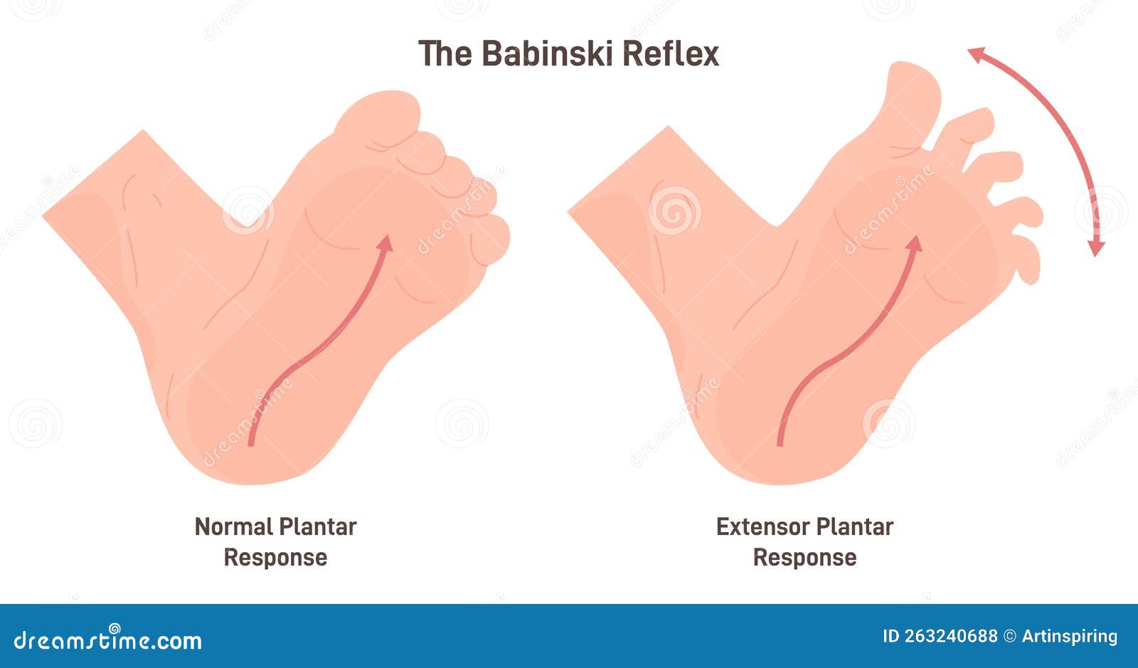 babinski reflex. stimulation of the lateral plantar aspect of the foot leads