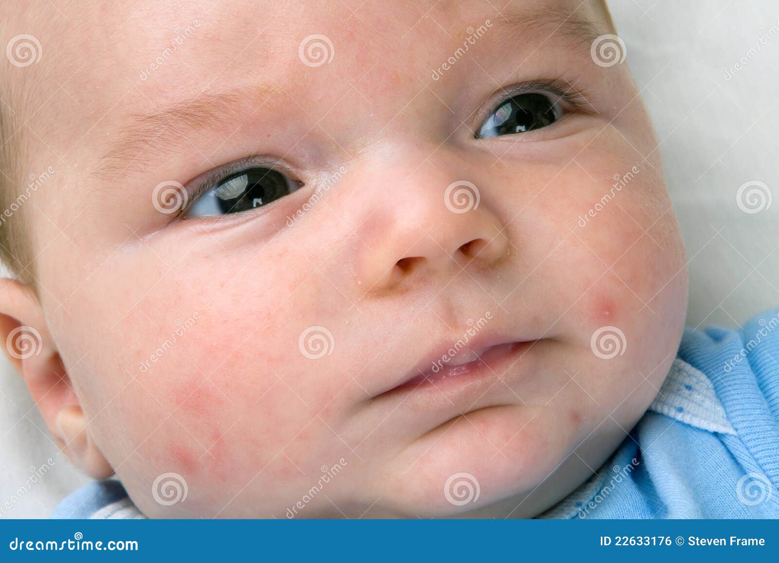 baby acne on newborn