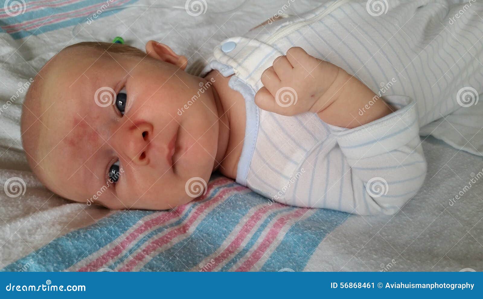 baby with angel kiss birthmarks on face