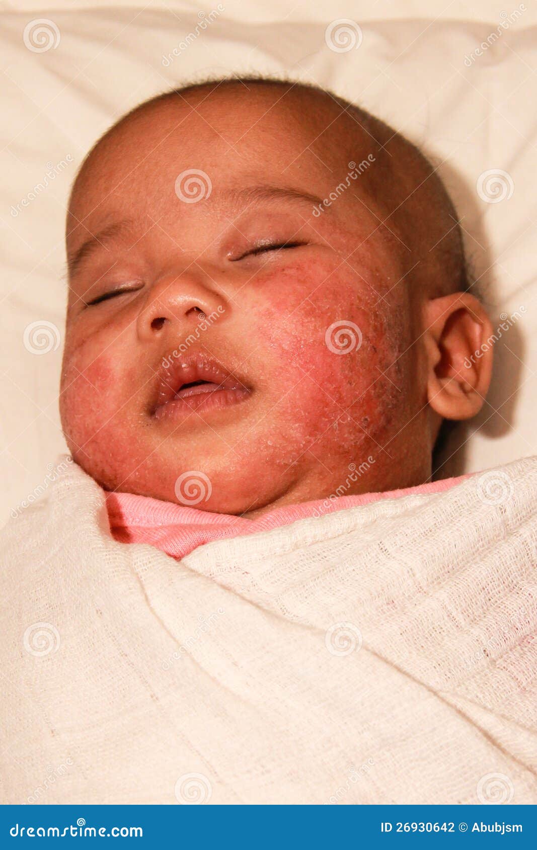 baby with atopic dermatitis