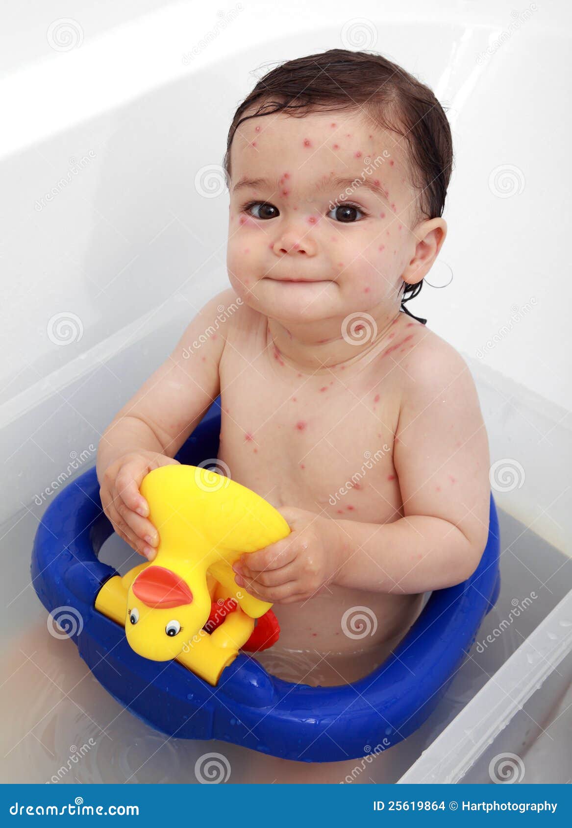 Baby in Bath Suffering with Chicken Pox Stock Photo - Image of immunity