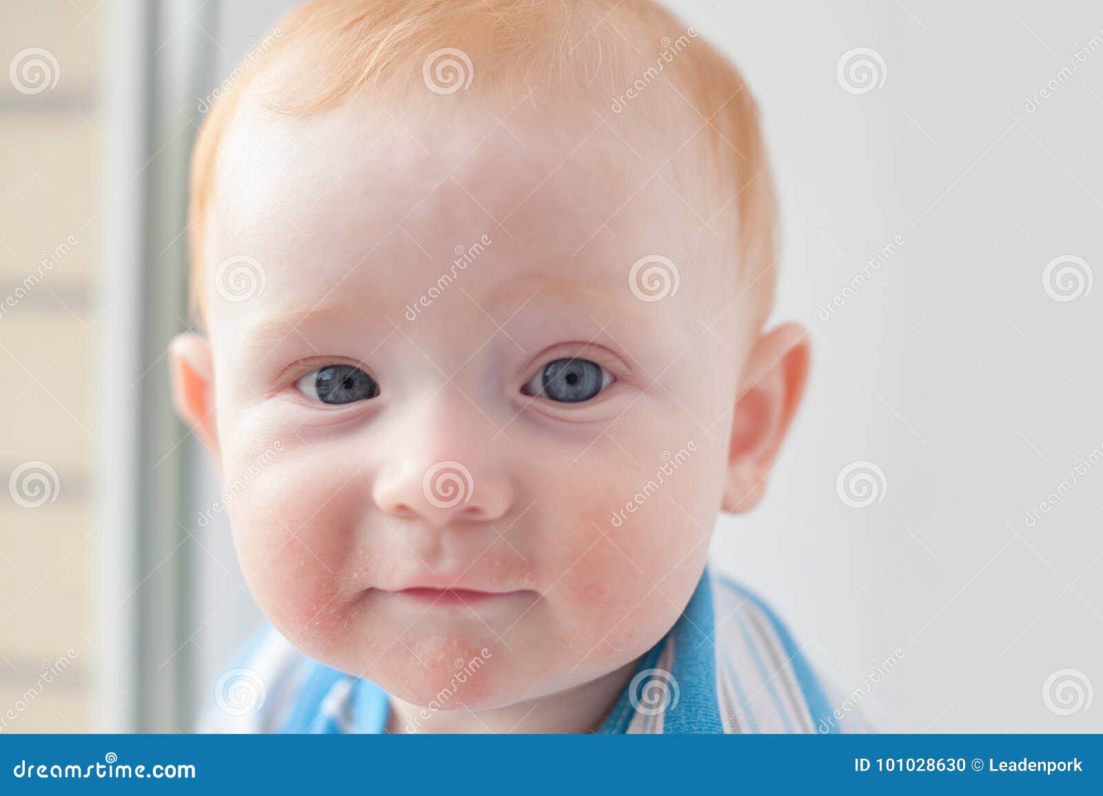 baby boy with atopic dermatitis