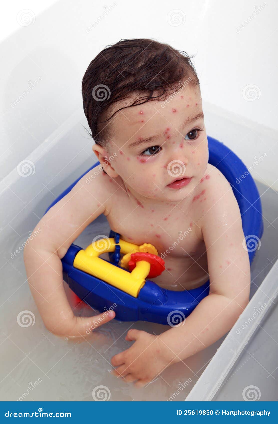 Baby with chicken pox stock photo. Image of immune, sick - 25619850