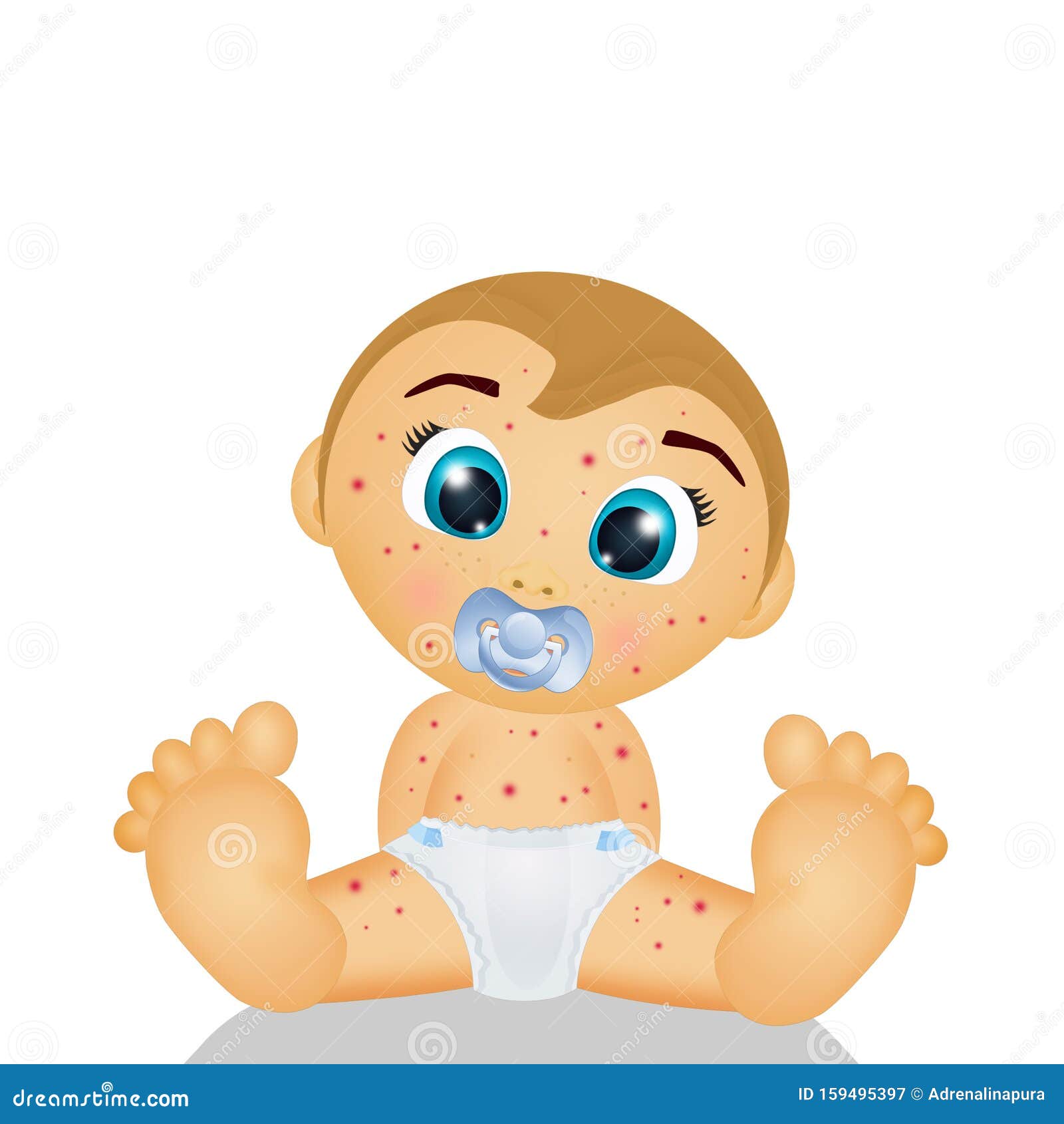 Baby with chicken pox stock illustration. Illustration of skin - 159495397 Baby with chicken pox stock illustration. Illustration of skin - 159495397