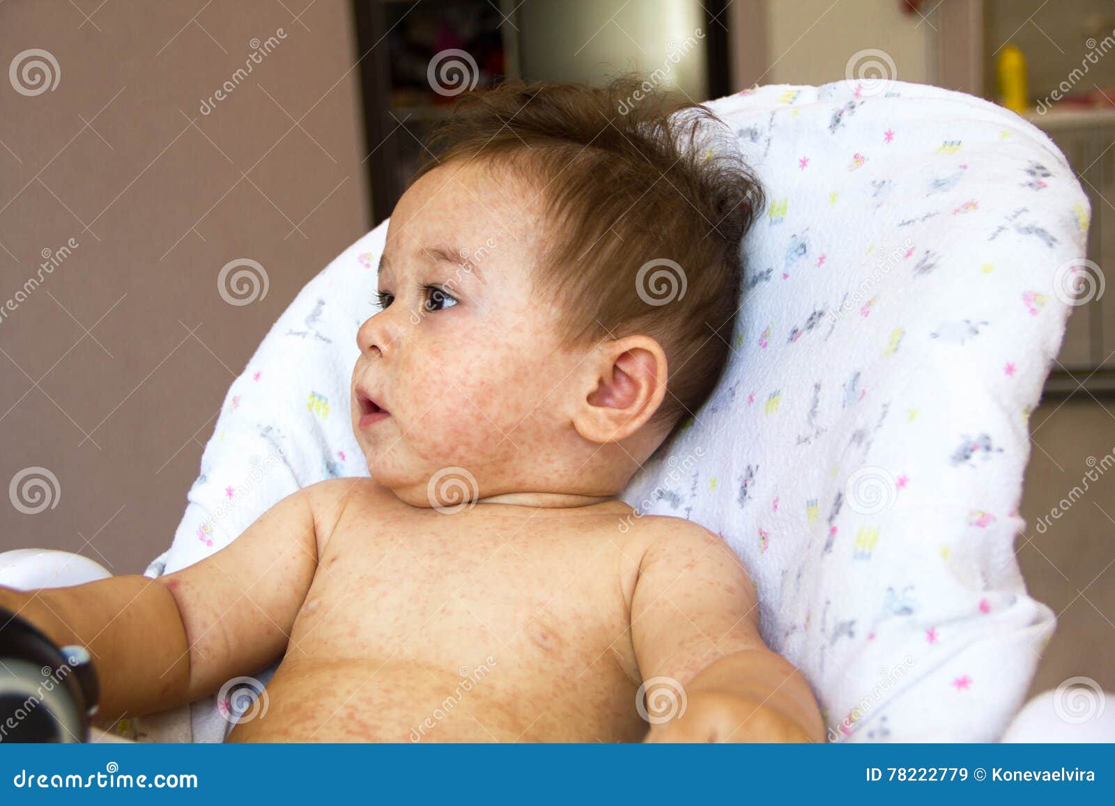Baby With Dermatitis Problem Of Rash Allergy Suffering From Food