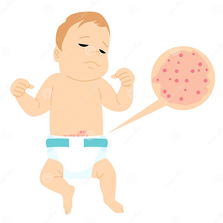 Baby with Diaper Rash Allergic Itching Stock Illustration