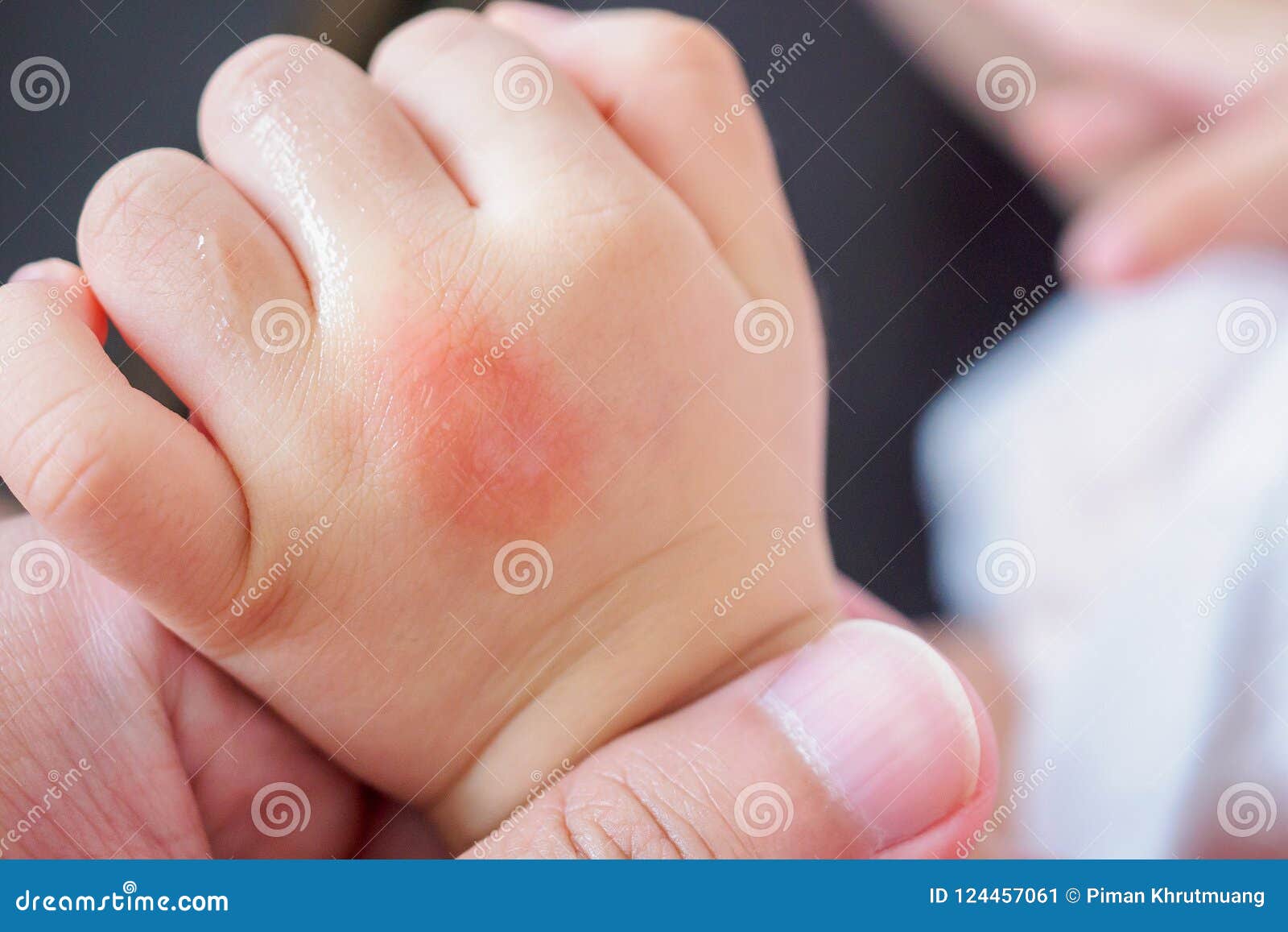 Baby Hand with Skin Rash and Allergy Red Spot Stock Image - of injury, bite: 124457061