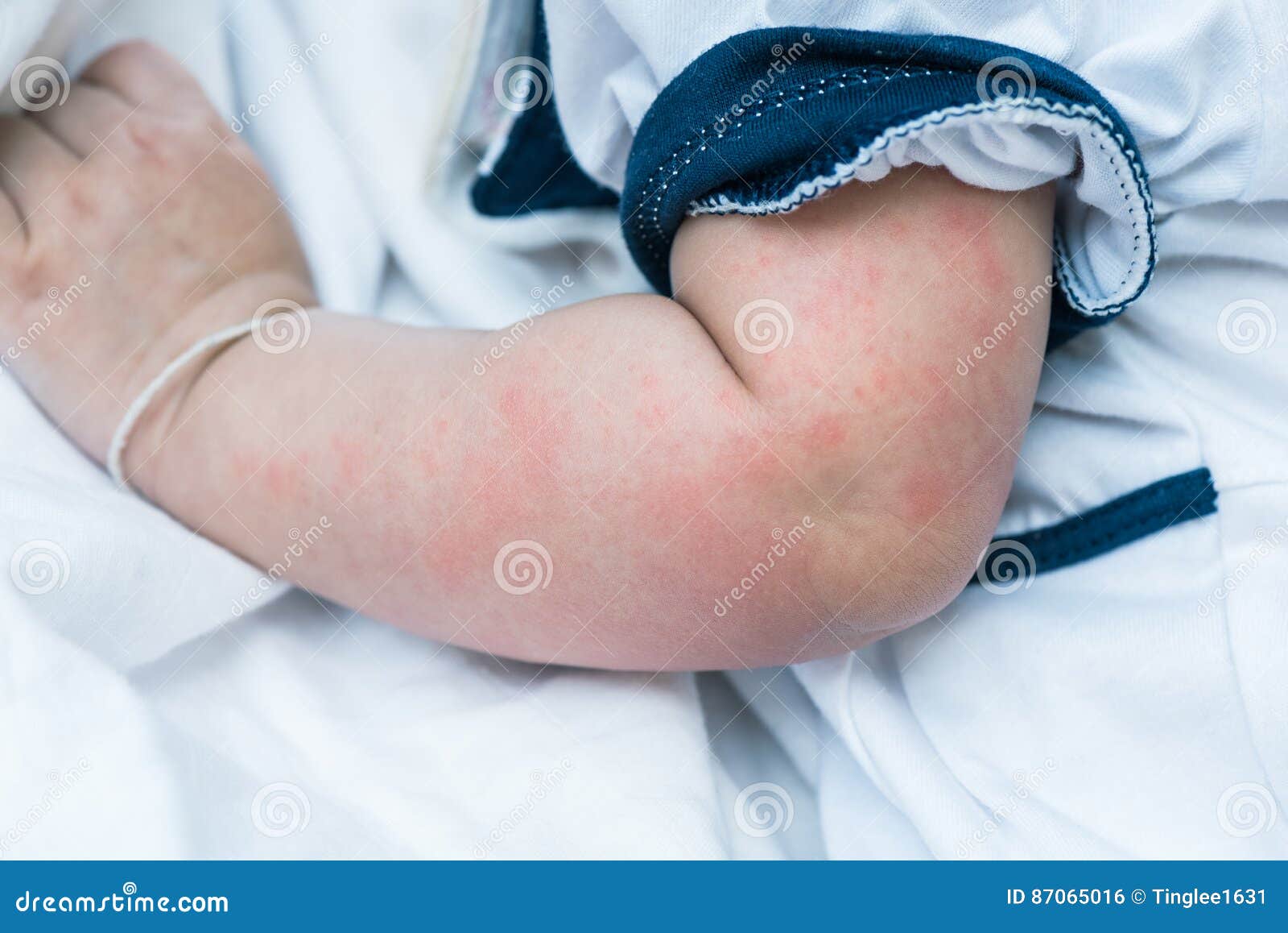 Baby Skin Texture Suffering Severe Urticaria, Nettle Rash. Stock Photo