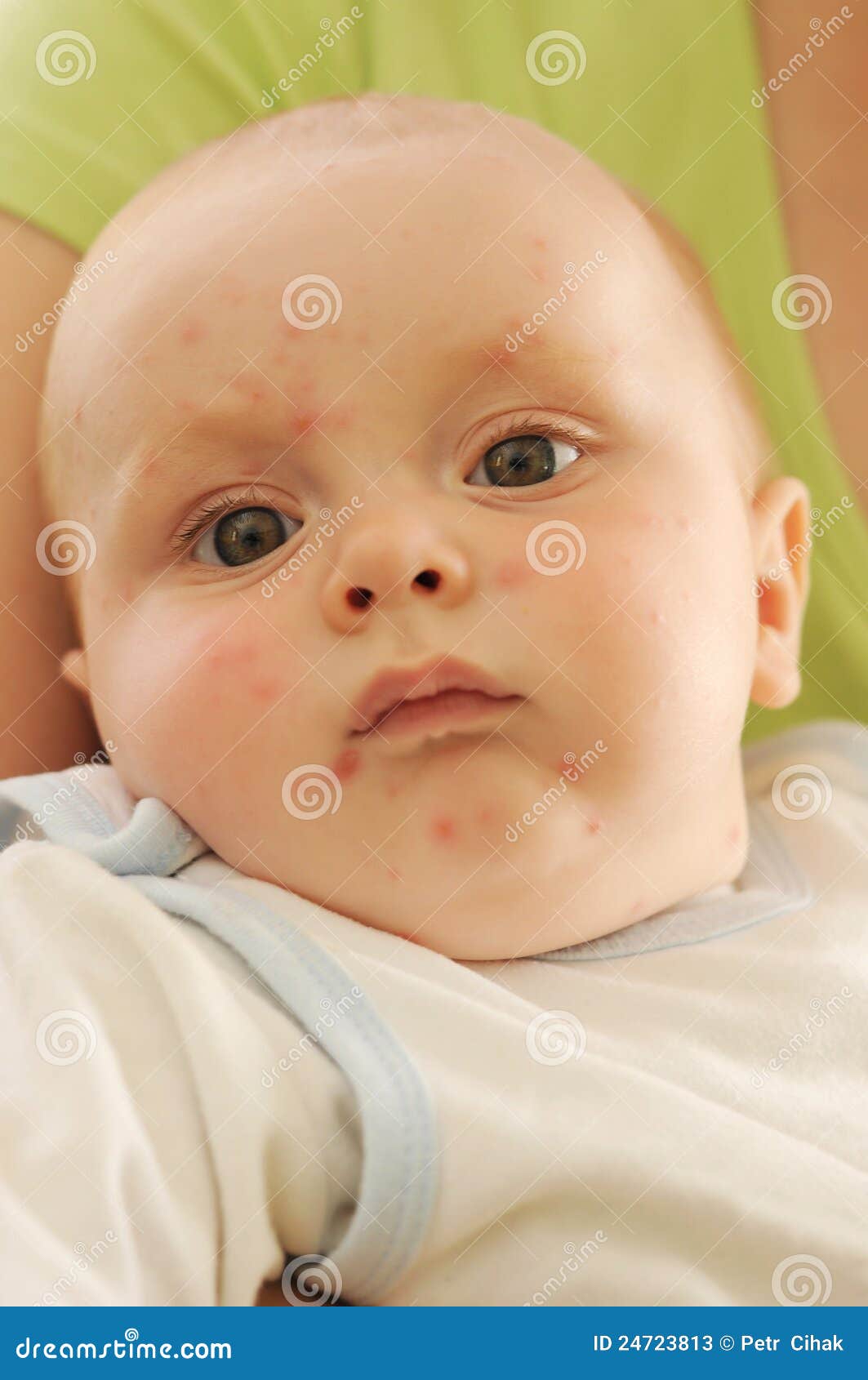 baby with smallpox