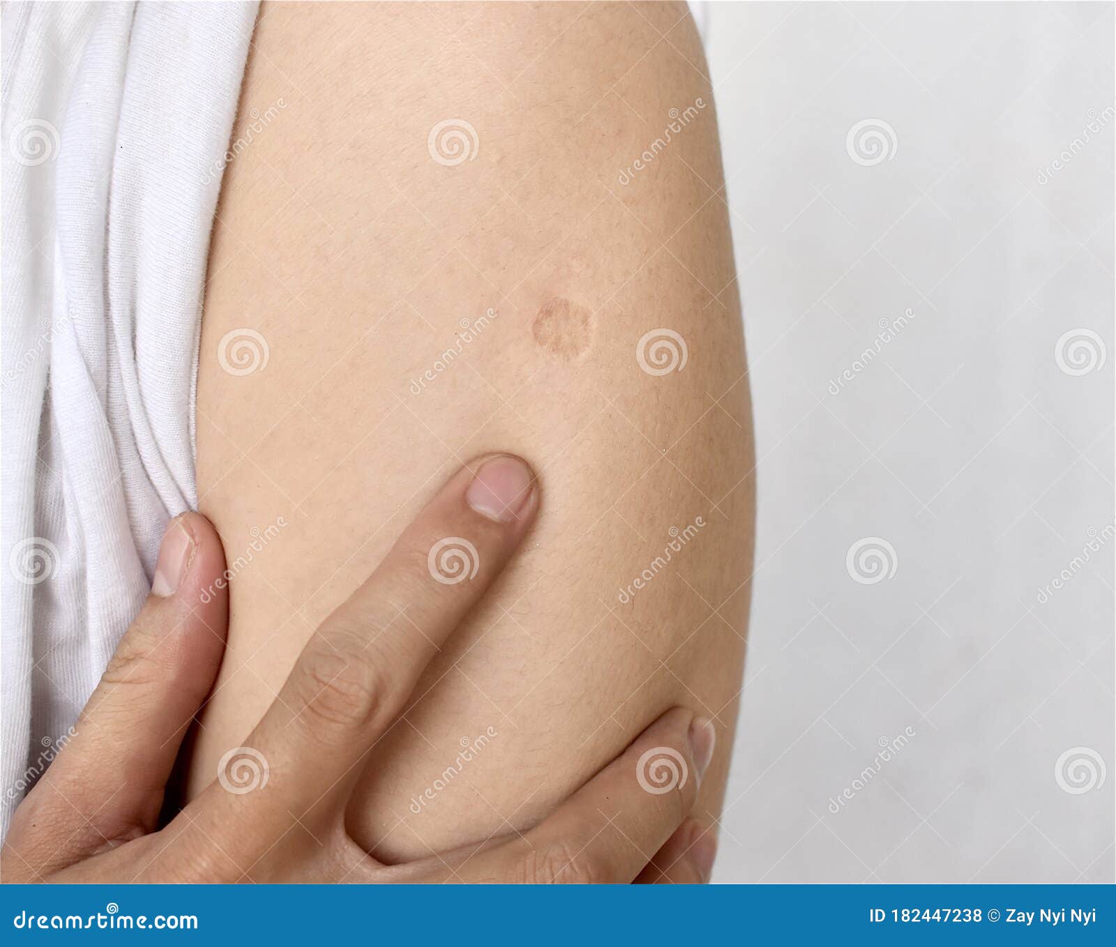 :bacillus calmette-guÃÂ©rin, bcg or tb vaccine scar in right arm of southeast asian, burmese adult y