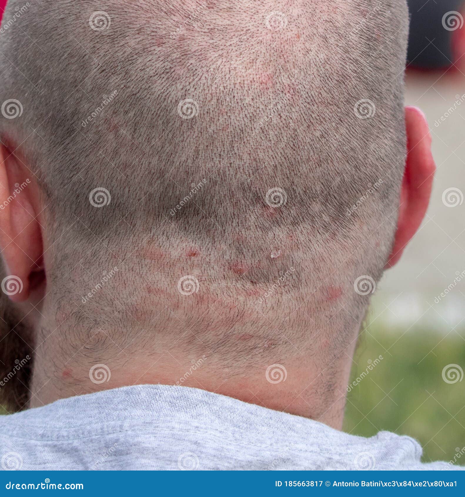 Back of the Head of a Short Haired Man Suffering from Scalp Acne Problem Stock Image - Image of allergy, hormone: 185663817 Back of the Head of a Short Haired Man Suffering from Scalp Acne Problem Stock Image - Image of allergy, hormone: 185663817