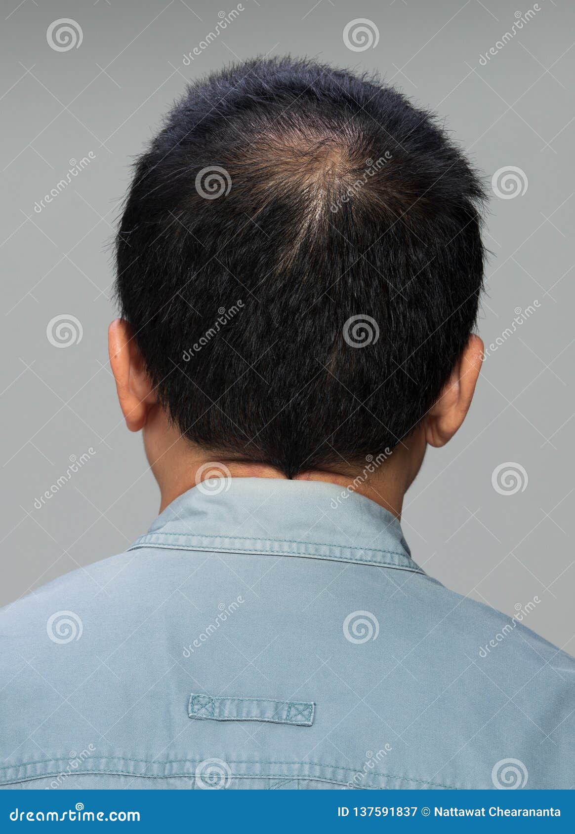 Back View Of Male Hair Head Part Bald Stock Image - Image of oily, male