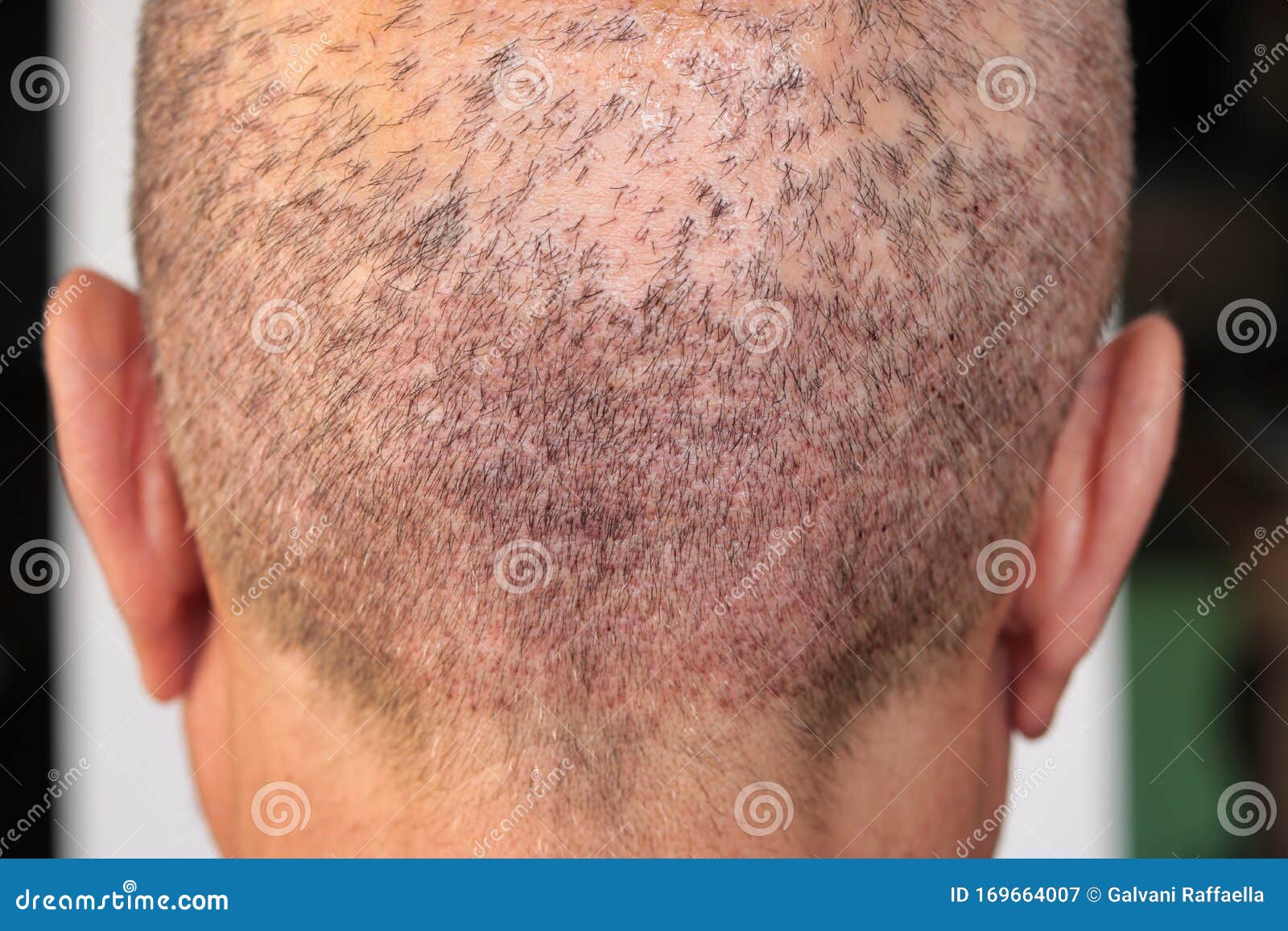 Back View of a Man`s Head with Hair Transplant Surgery Area Stock Image - Image of isolated, head: 169664007 Back View of a Man`s Head with Hair Transplant Surgery Area Stock Image - Image of isolated, head: 169664007