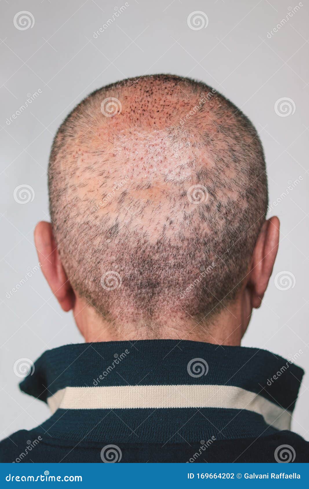 Back View of a Man`s Head Who Has Done a Self Hair Transplant Stock Photo - Image of help, balding: 169664202 Back View of a Man`s Head Who Has Done a Self Hair Transplant Stock Photo - Image of help, balding: 169664202