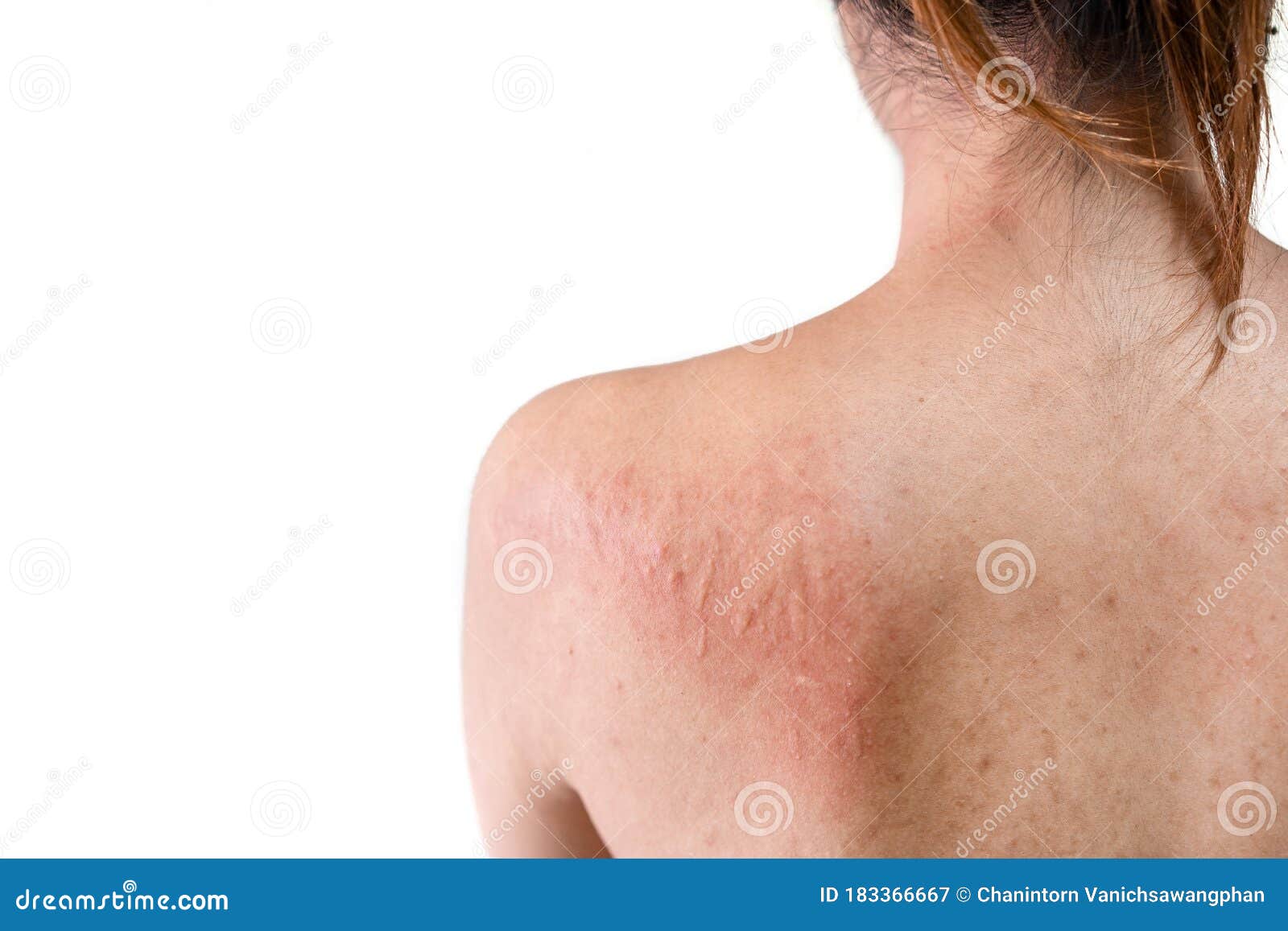 Back of Young Asian Woman Have Itchy with Allergy Rash on White
