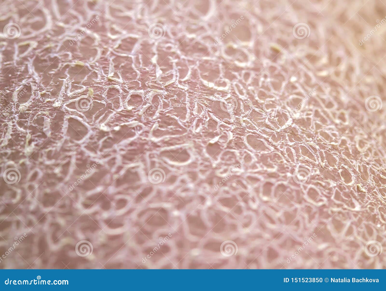 Background of Dry Unhealthy Skin Texture Close-up Covered with Small and Large Cracks and Dead Flaky Scales Sun Stock Photo - Image of female, 151523850