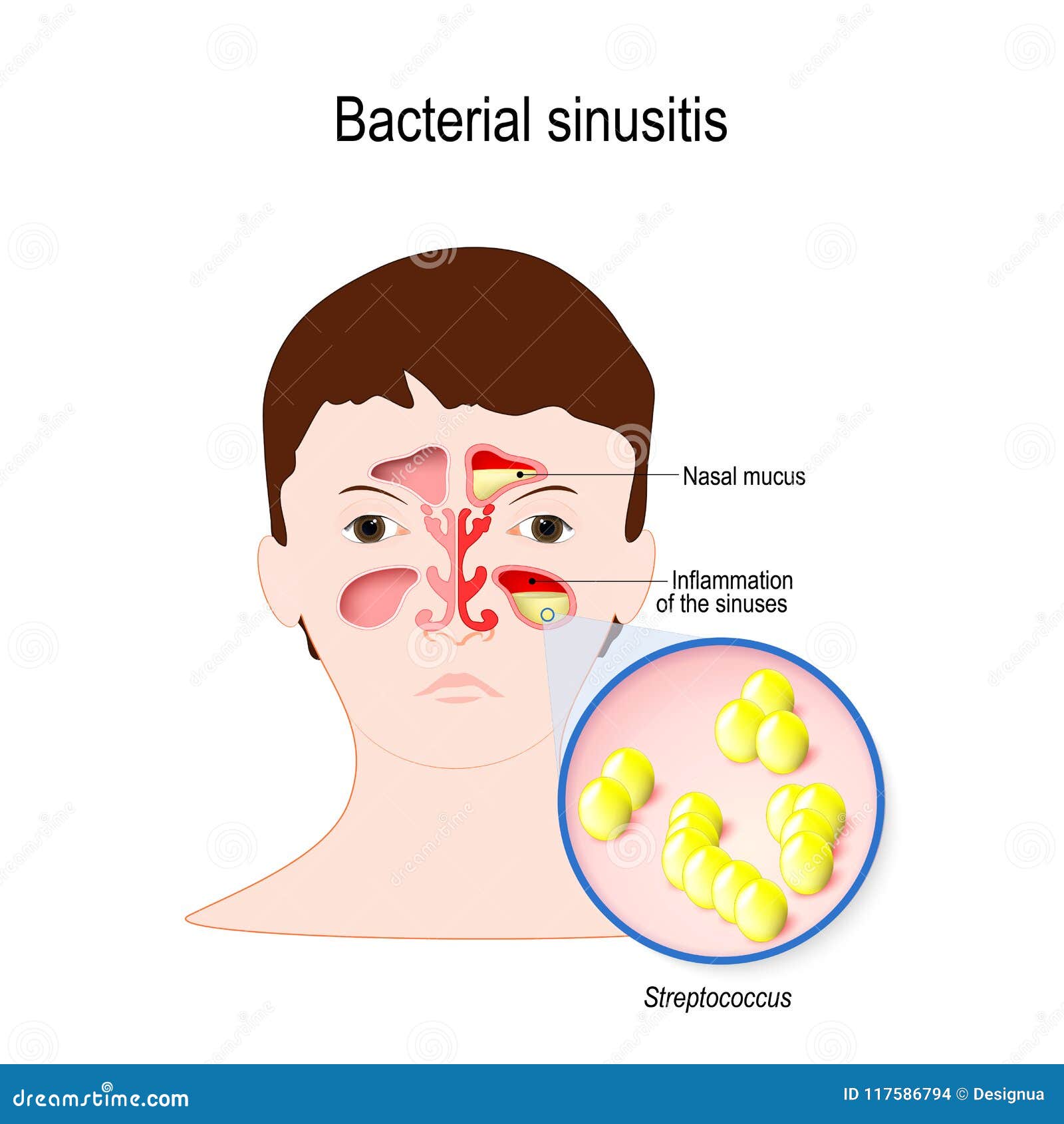 bacterial sinusitis. rhinitis