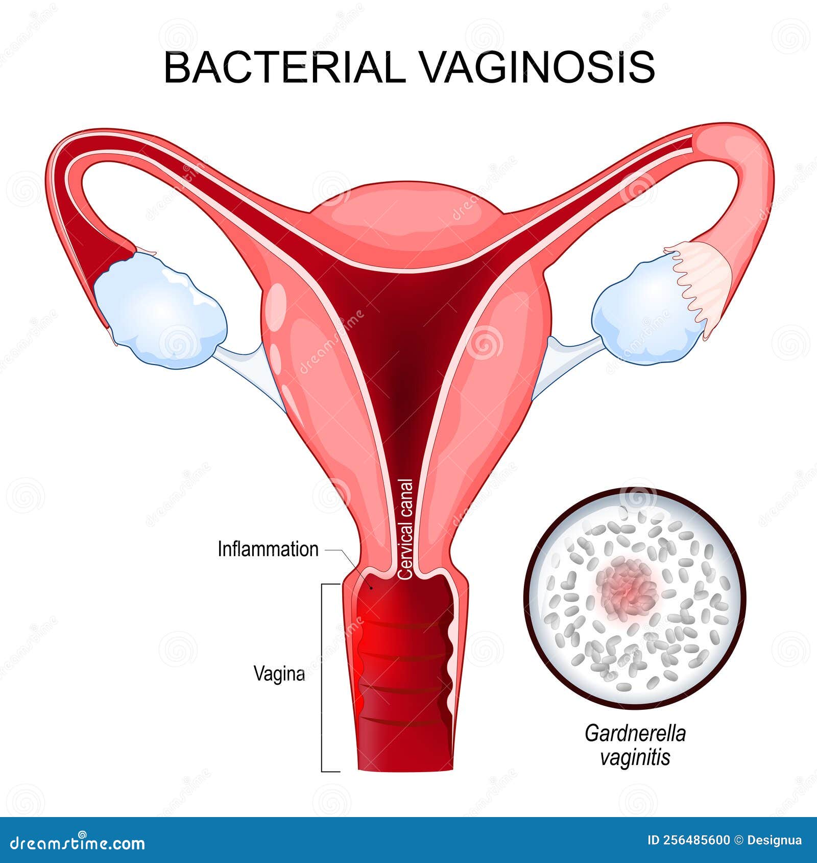 bacterial vaginosis. cross section of human uterus. close-up of g. vaginalis.