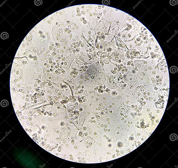 Bactéries Modérées Et Globules Blancs Dans Les Bactéries Patientes Infection Urinaire Photo
