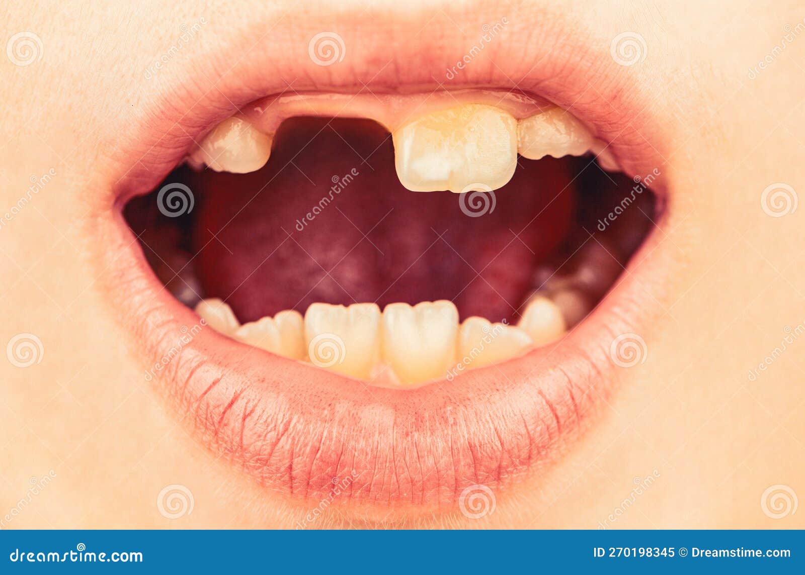 Bad Teeth Child. Portrait Boy with Bad Teeth. Close Up of Unhealthy