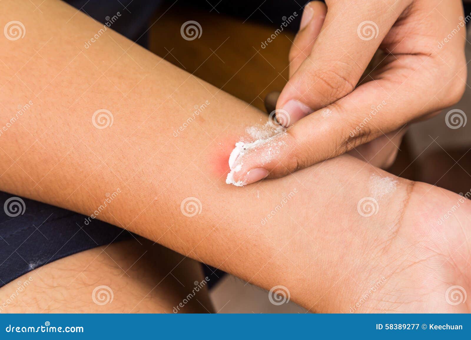 baking soda being used to relieve itching from insect bites.