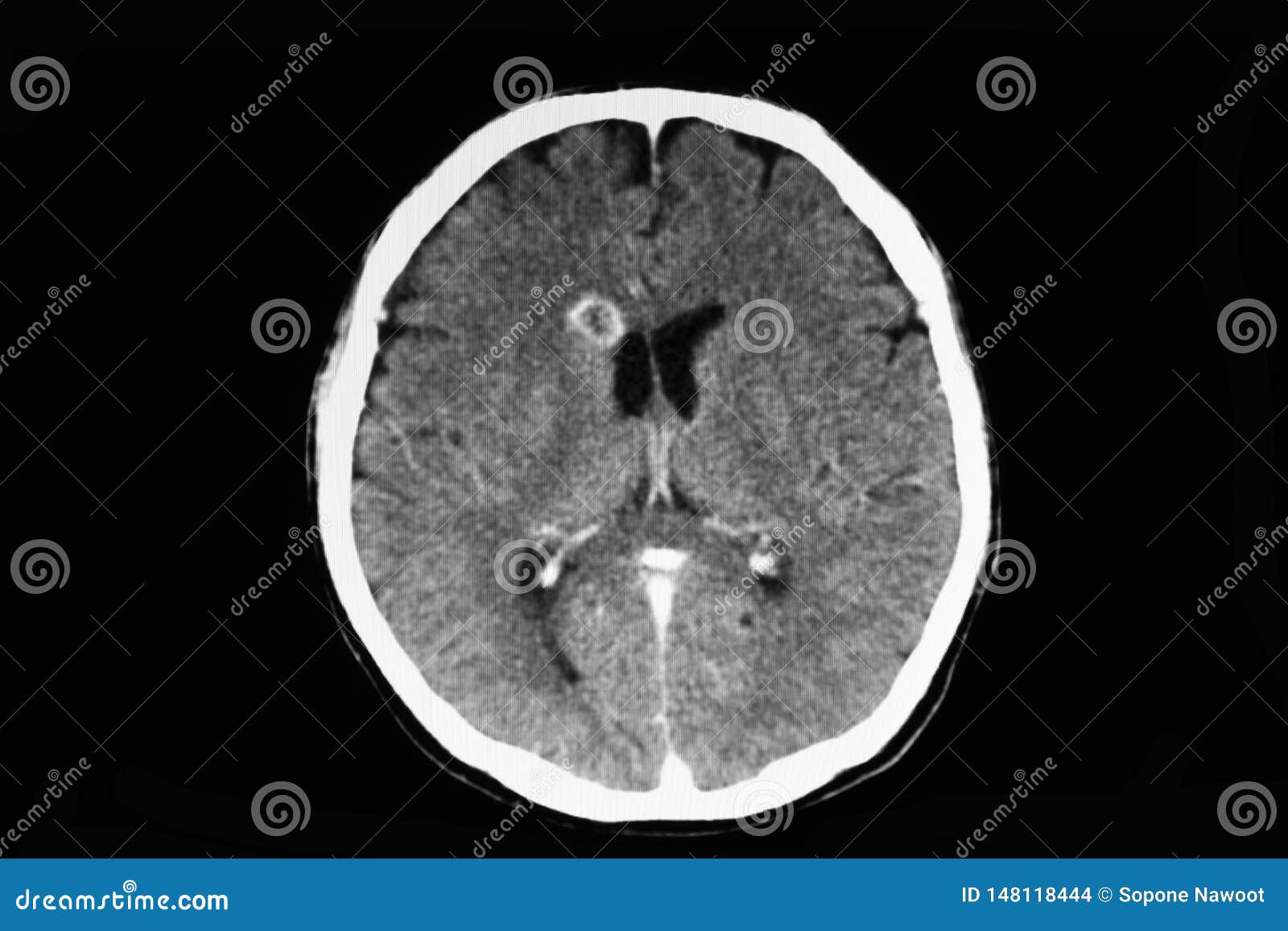 Balayage De CT D'un Patient Présentant L'abcès De Cerveau Photo ...