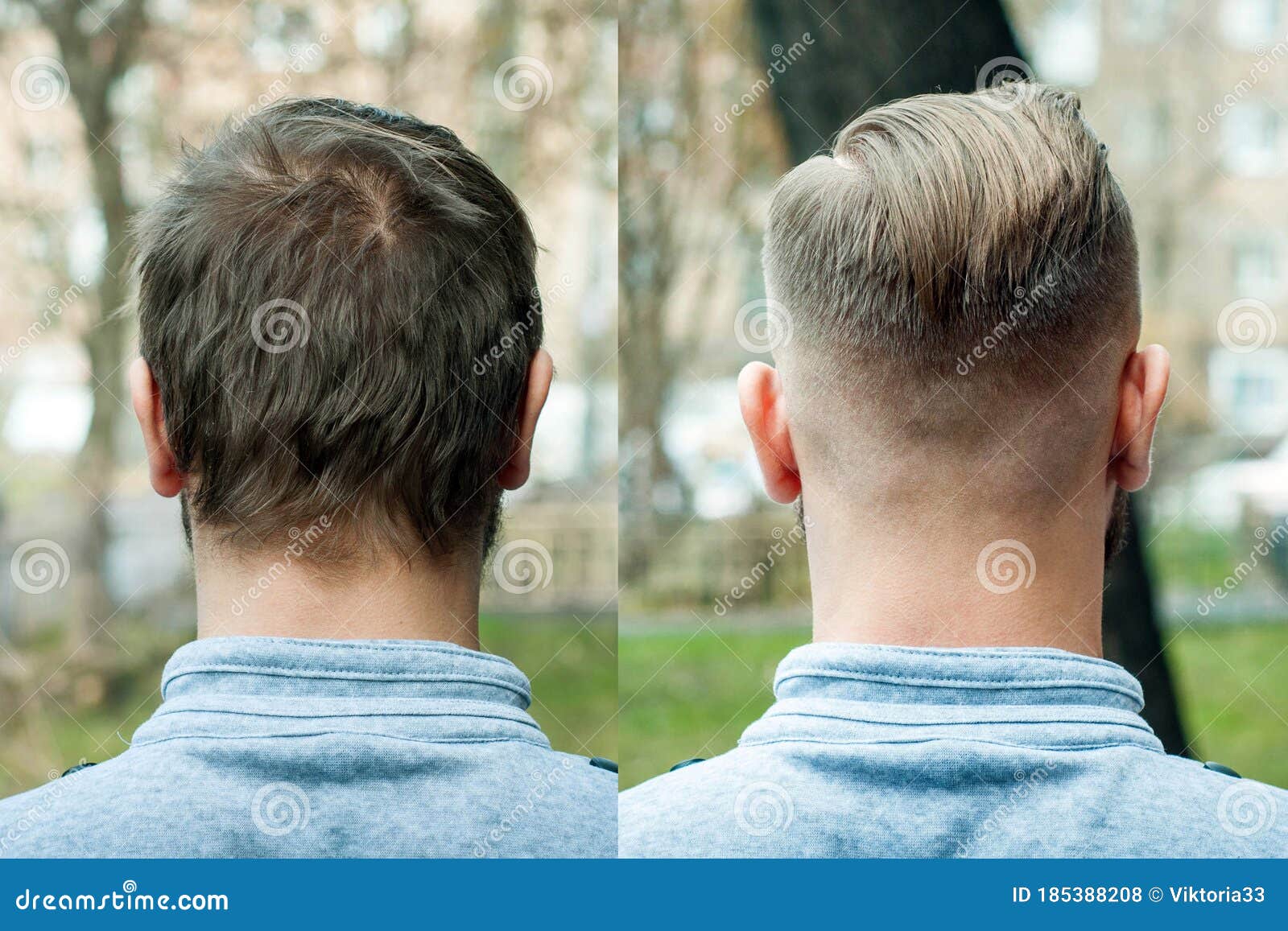 Bald Guy before after Haircut Concept for a Barber Shop: the Problem Man of  Hair Loss, Alopecia, Transplantation, Back Stock Photo - Image of male,  shaggy: 185388208