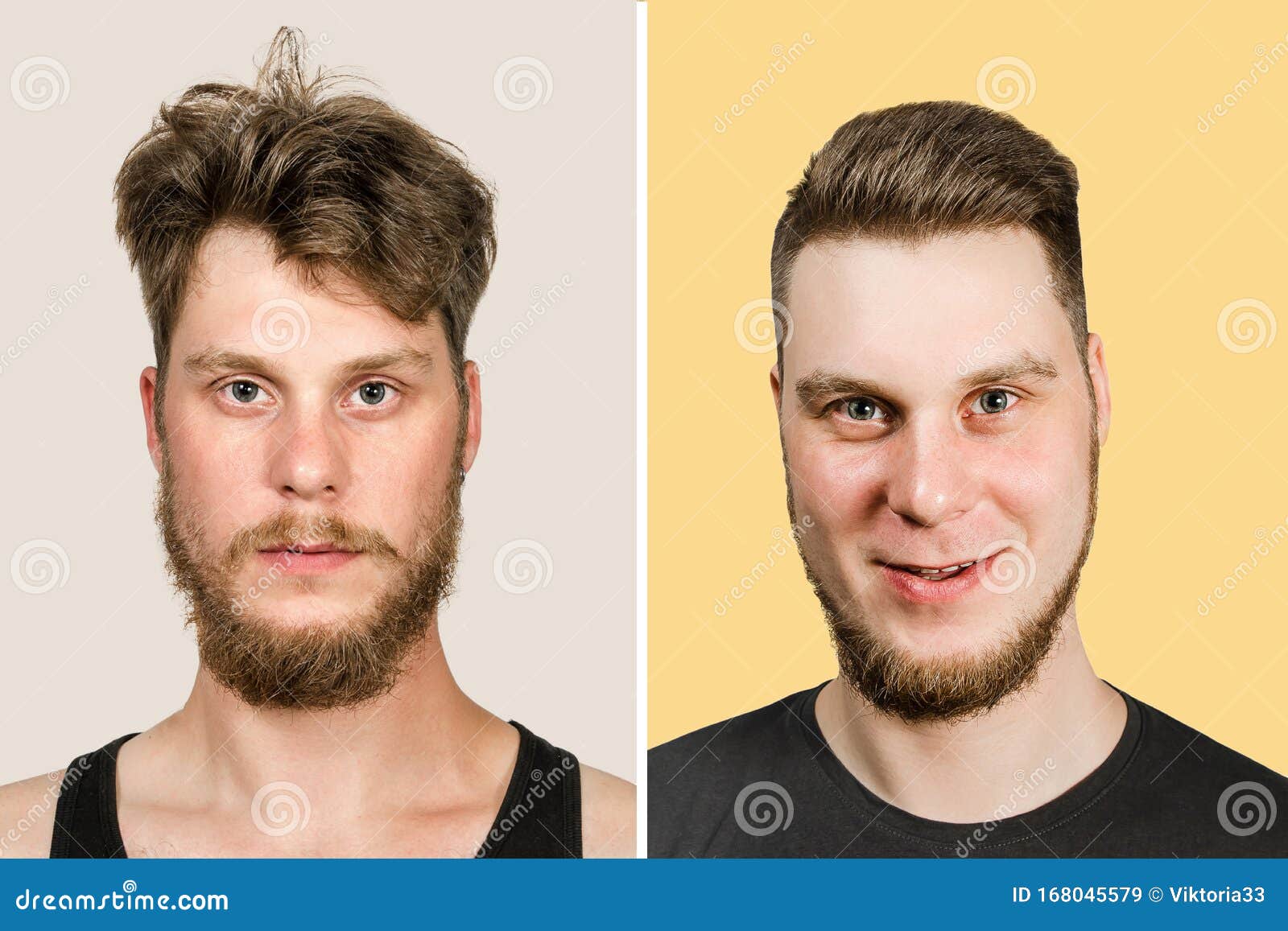 Bald Guy before after Haircut Concept for a Barber Shop: the Problem Man of  Hair Loss, Alopecia, Transplantation Stock Image - Image of clip, brunette:  168045579