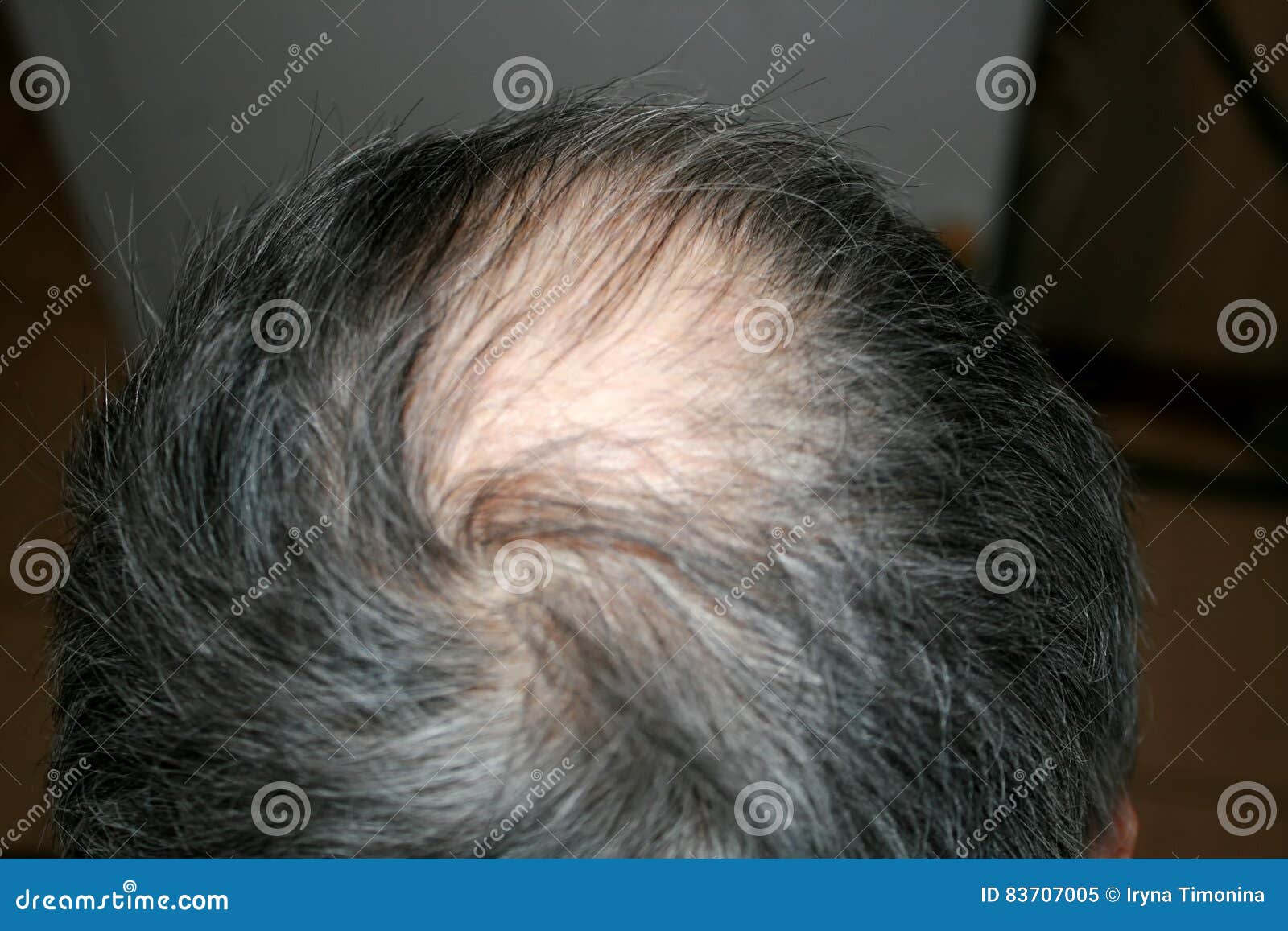 bald head of a man. receding hairline.