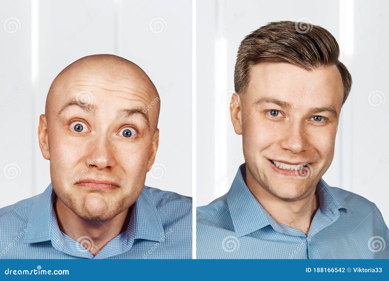 Bald Man before and after Transplant Hair and Alopecia Stock Photo - Image of beard, face: 188166542 Bald Man before and after Transplant Hair and Alopecia Stock Photo - Image of beard, face: 188166542