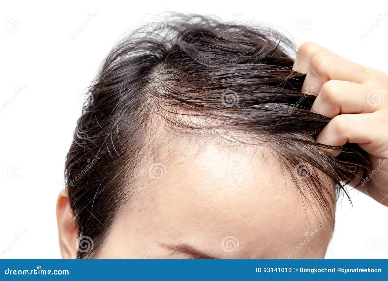 bald man or woman worry about his or her less hairline